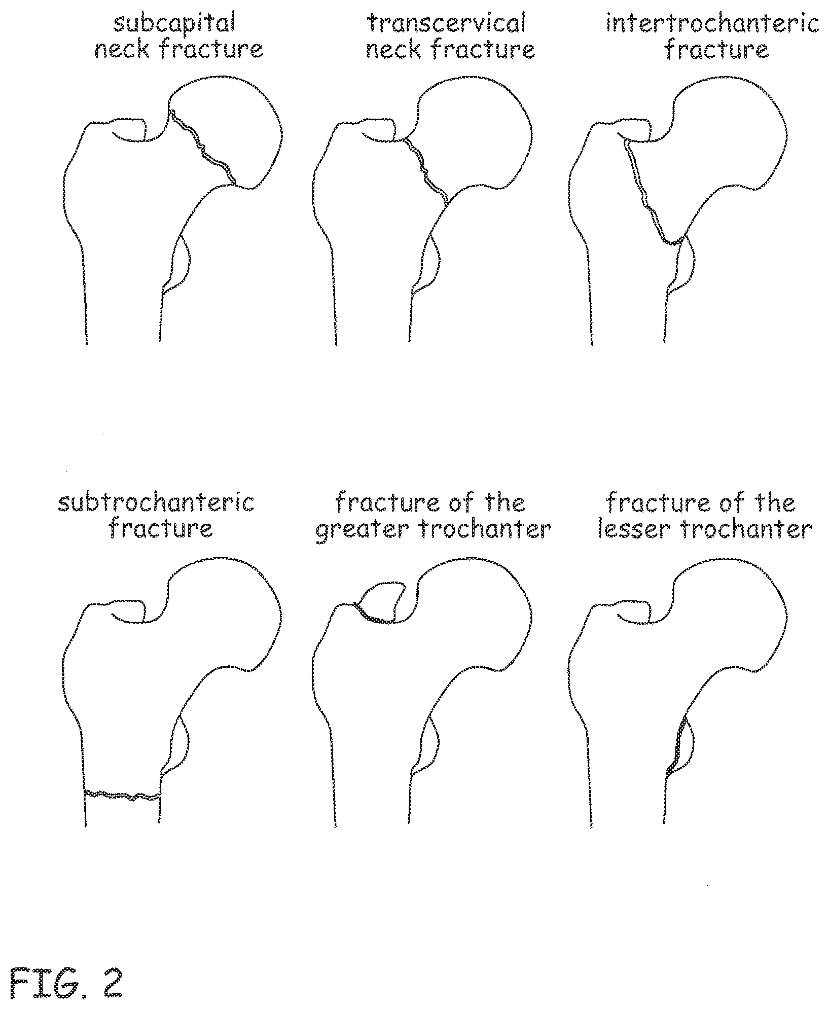 Patent US12496106 Figure 2 – Devices, methods and systems for remedying or preventing fractures