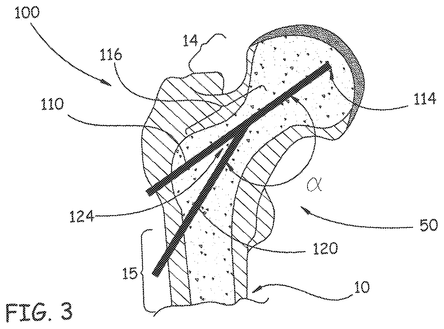 Patent US12496106 Figure 3 – Devices, methods and systems for remedying or preventing fractures