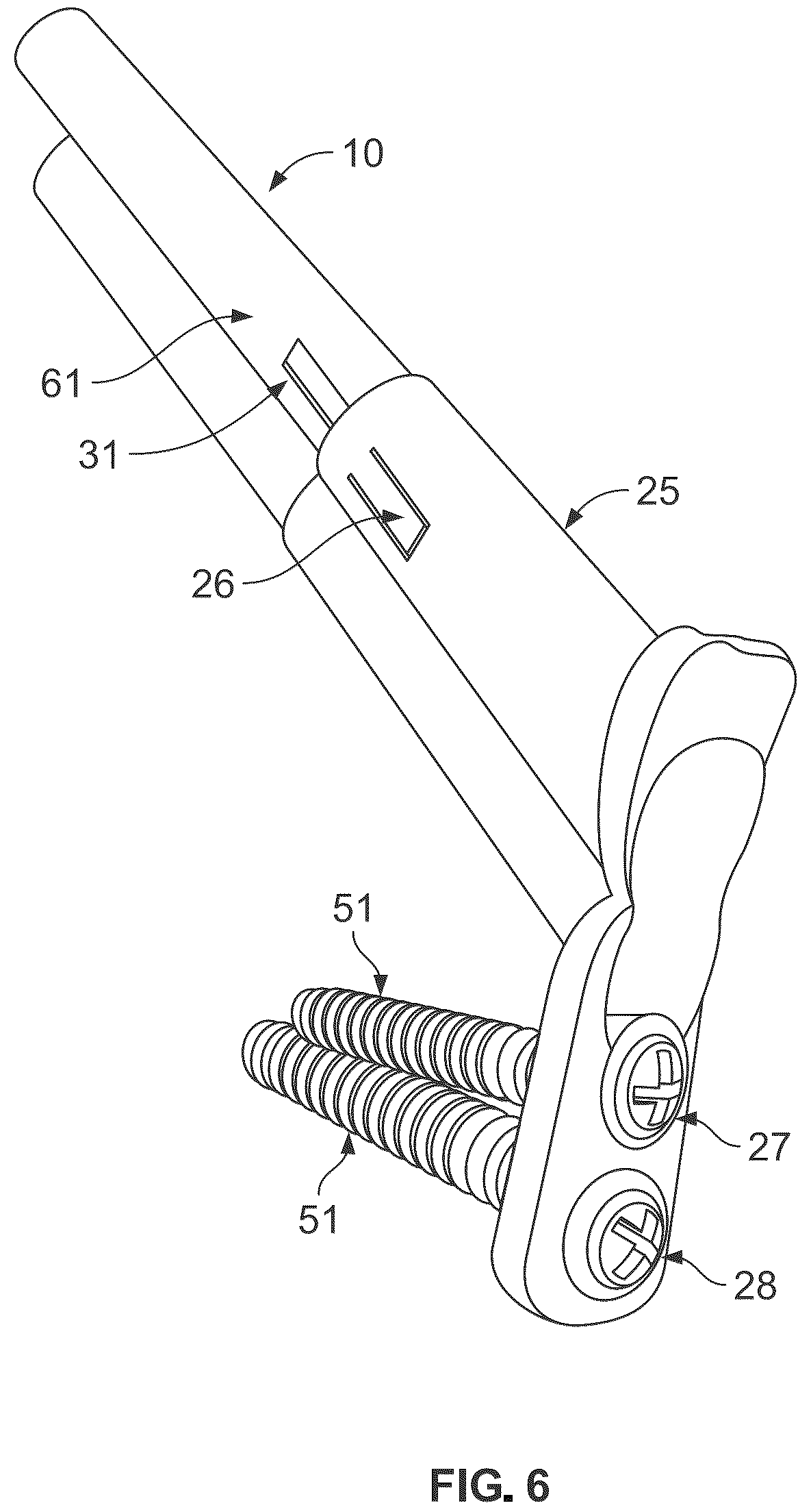 Patent US12496107 Figure 5 – Fracture fixation system