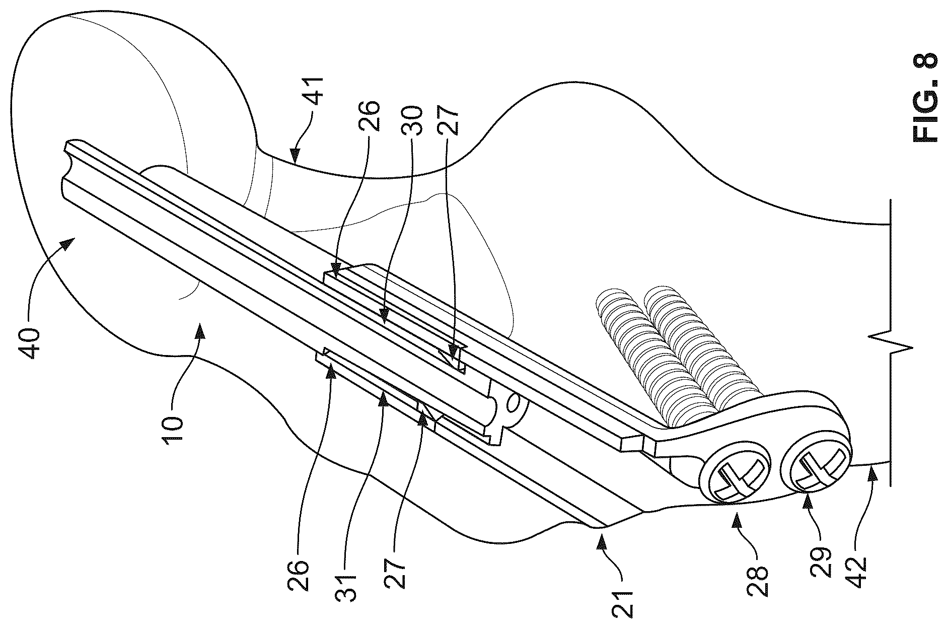 Patent US12496107 Figure 7 – Fracture fixation system