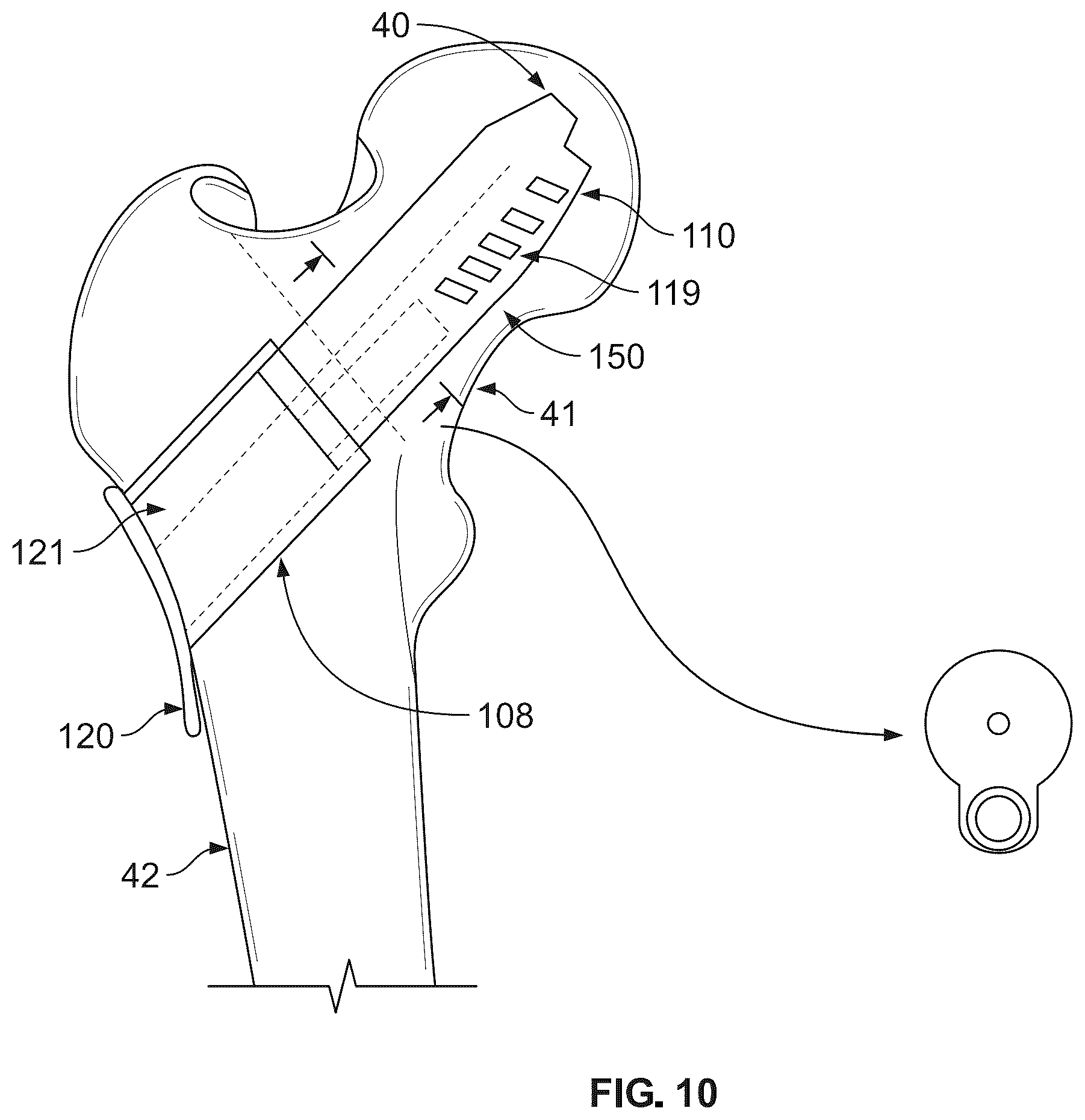Patent US12496107 Figure 9 – Fracture fixation system