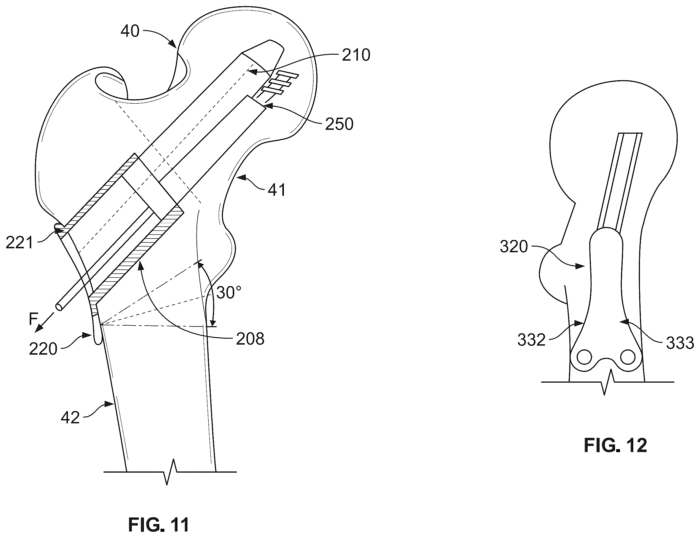 Patent US12496107 Figure 10 – Fracture fixation system