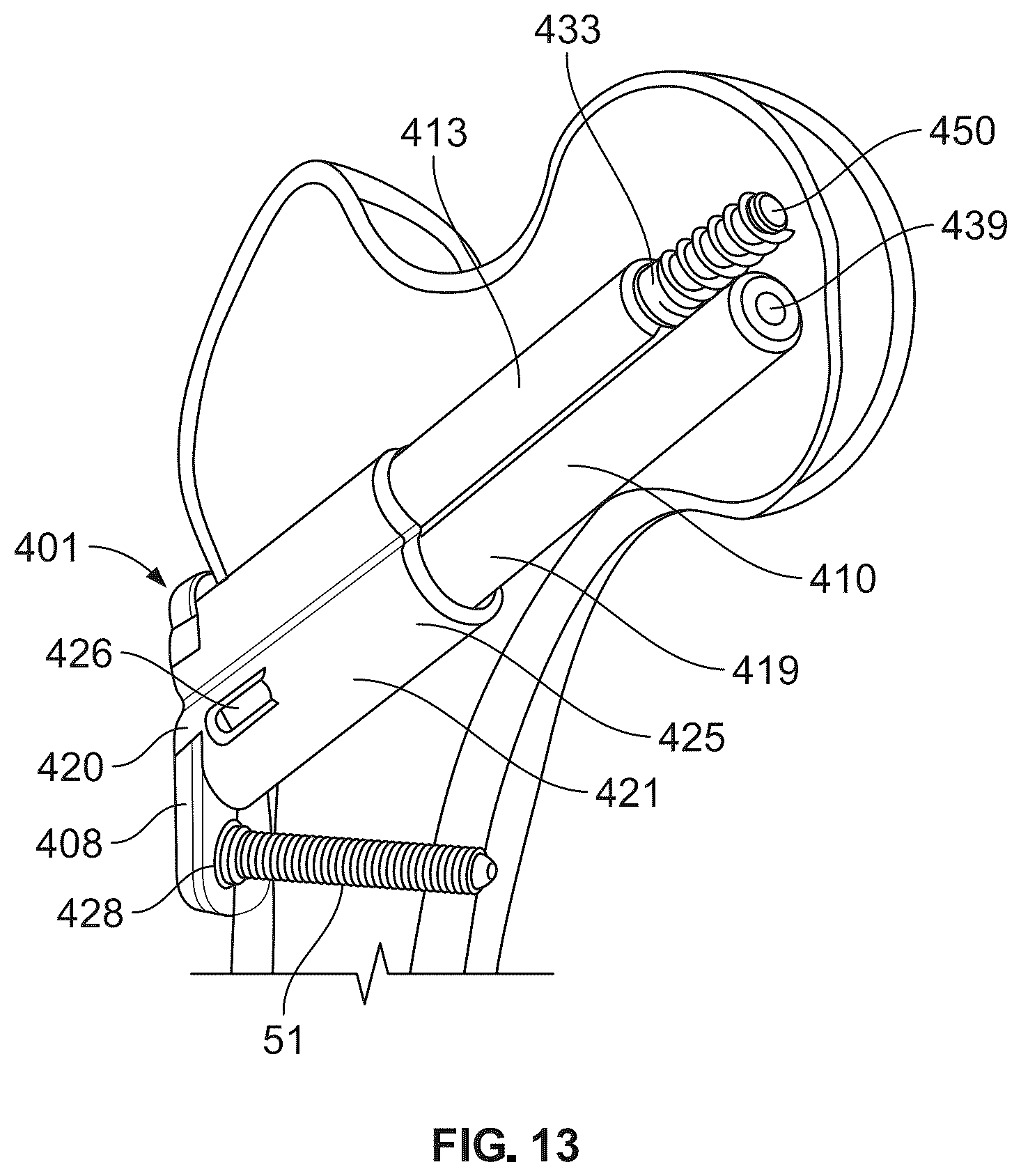 Patent US12496107 Figure 11 – Fracture fixation system