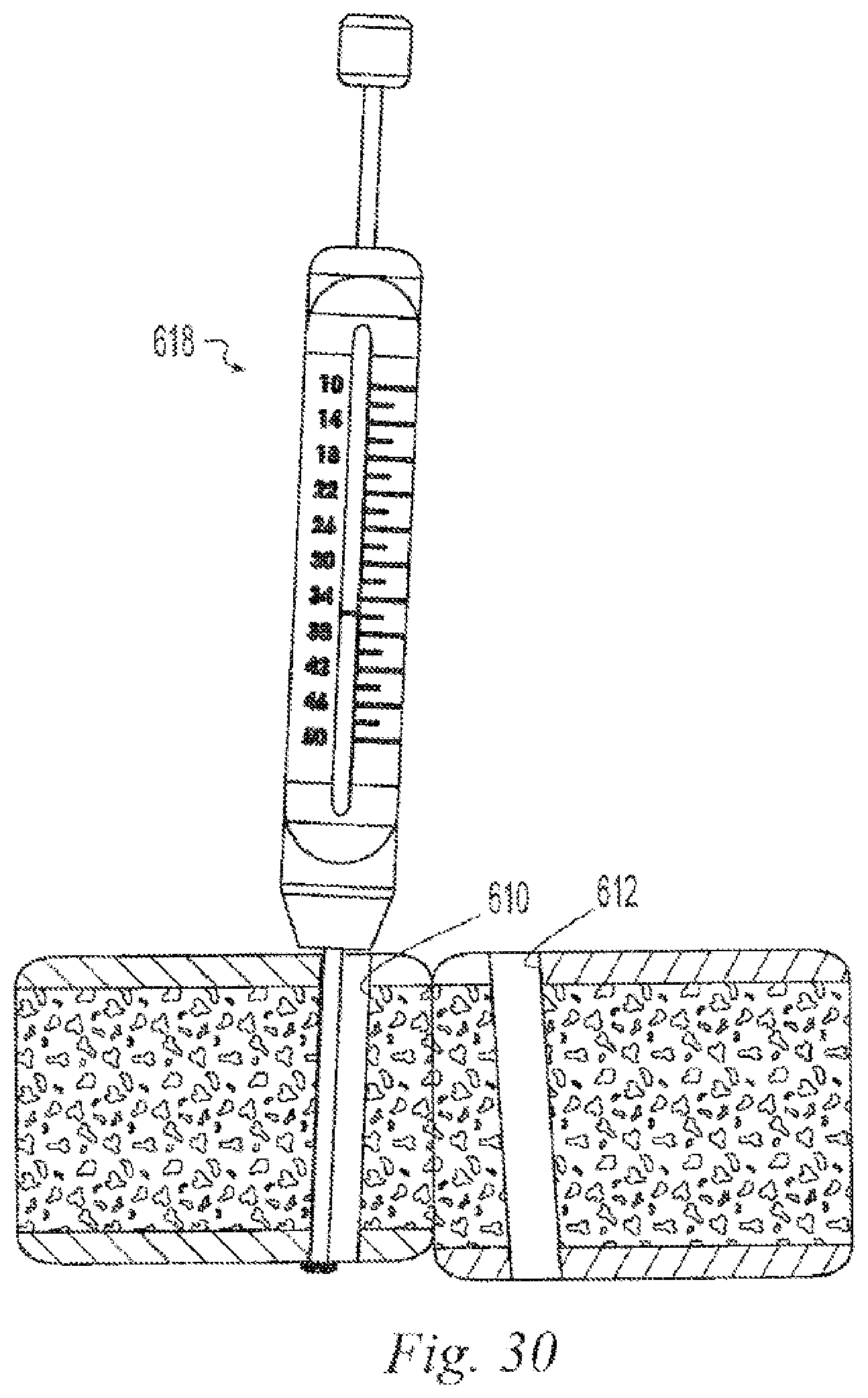 Patent US12496108 Figure 11 – Orthopedic fasteners, instruments and methods