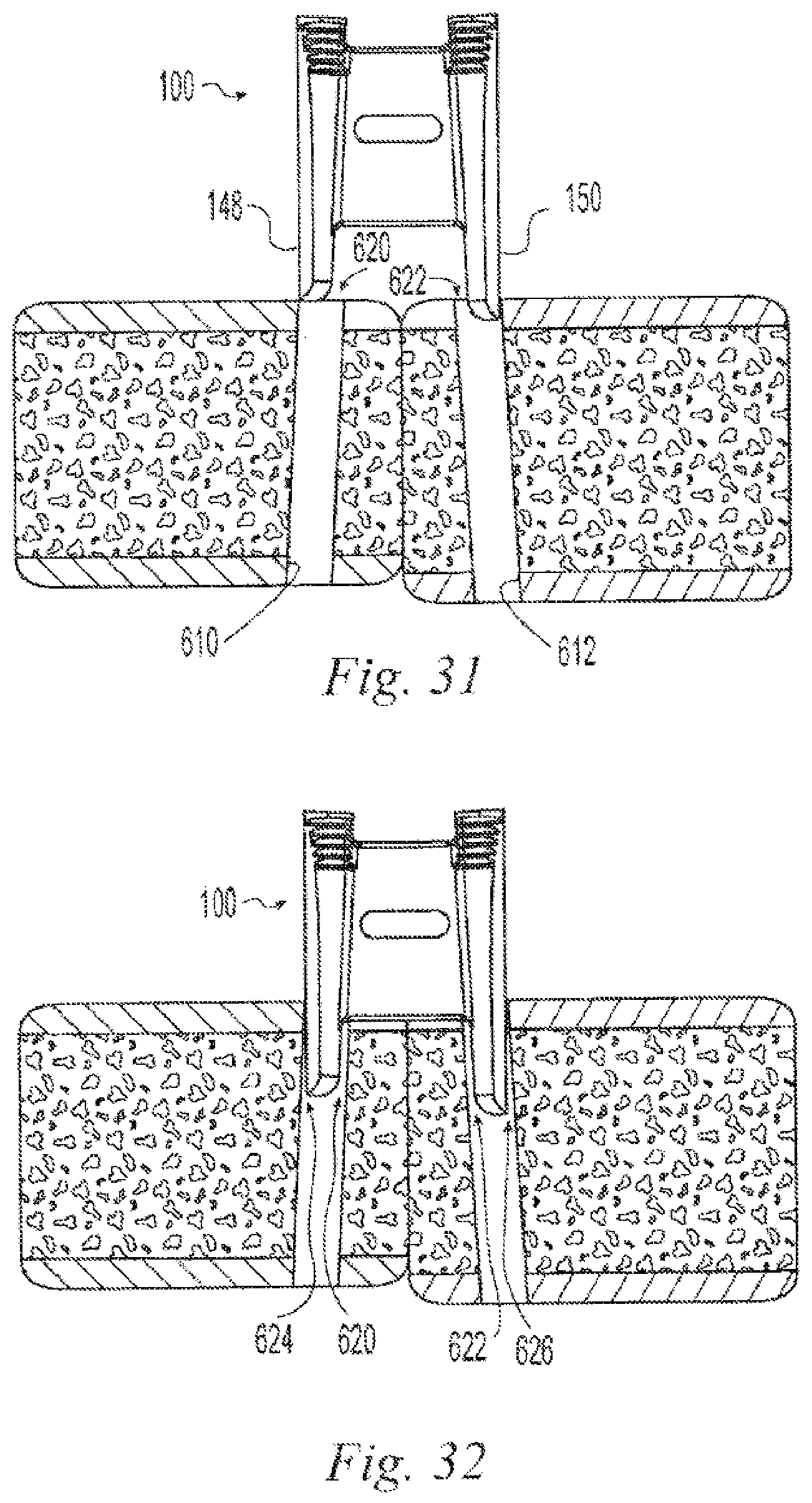 Patent US12496108 Figure 12 – Orthopedic fasteners, instruments and methods