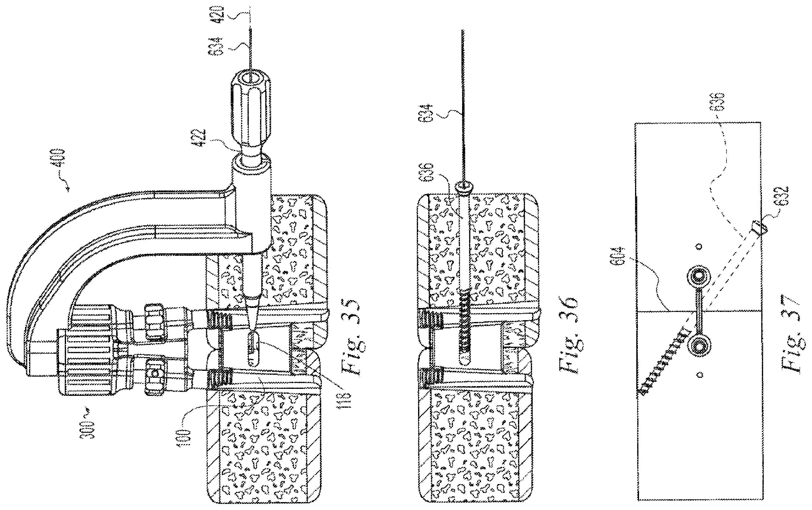 Patent US12496108 Figure 14 – Orthopedic fasteners, instruments and methods
