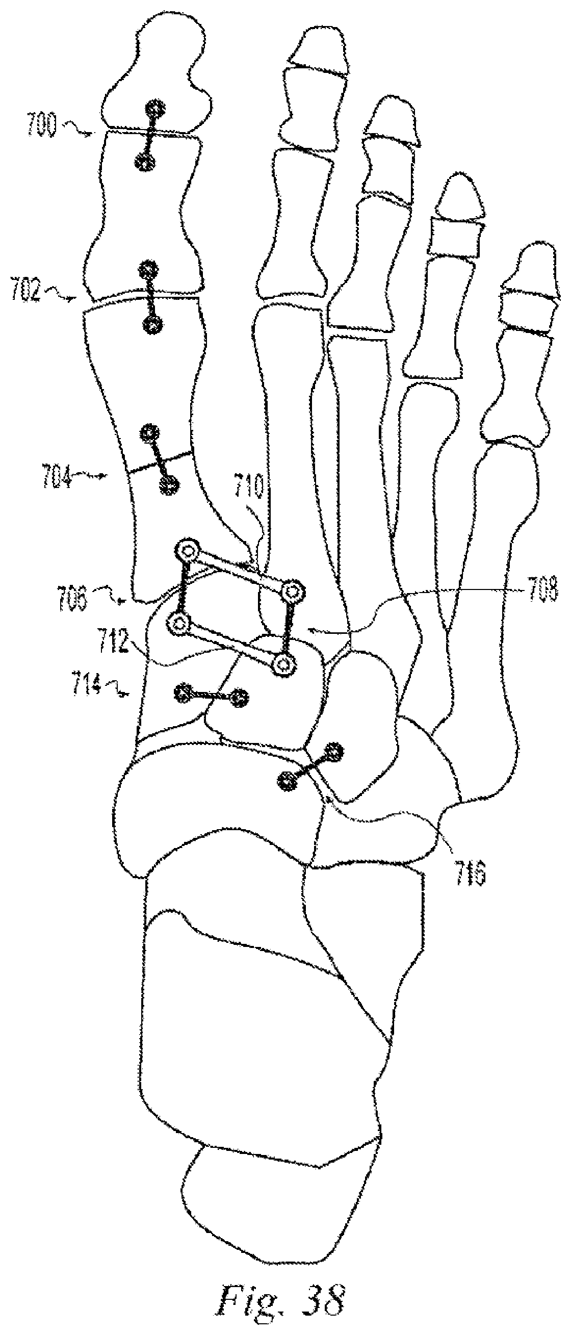 Patent US12496108 Figure 15 – Orthopedic fasteners, instruments and methods