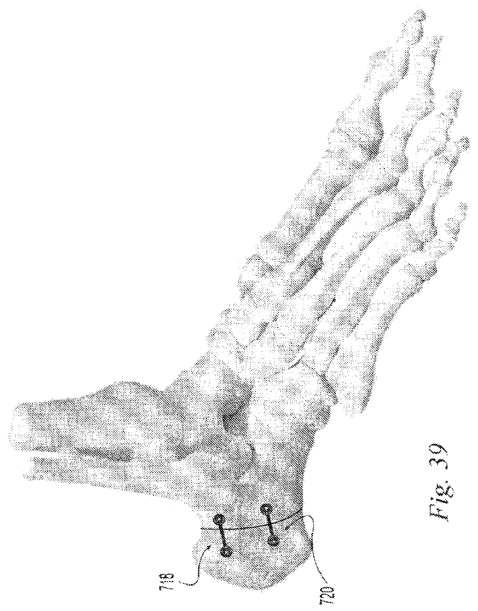 Patent US12496108 Figure 16 – Orthopedic fasteners, instruments and methods