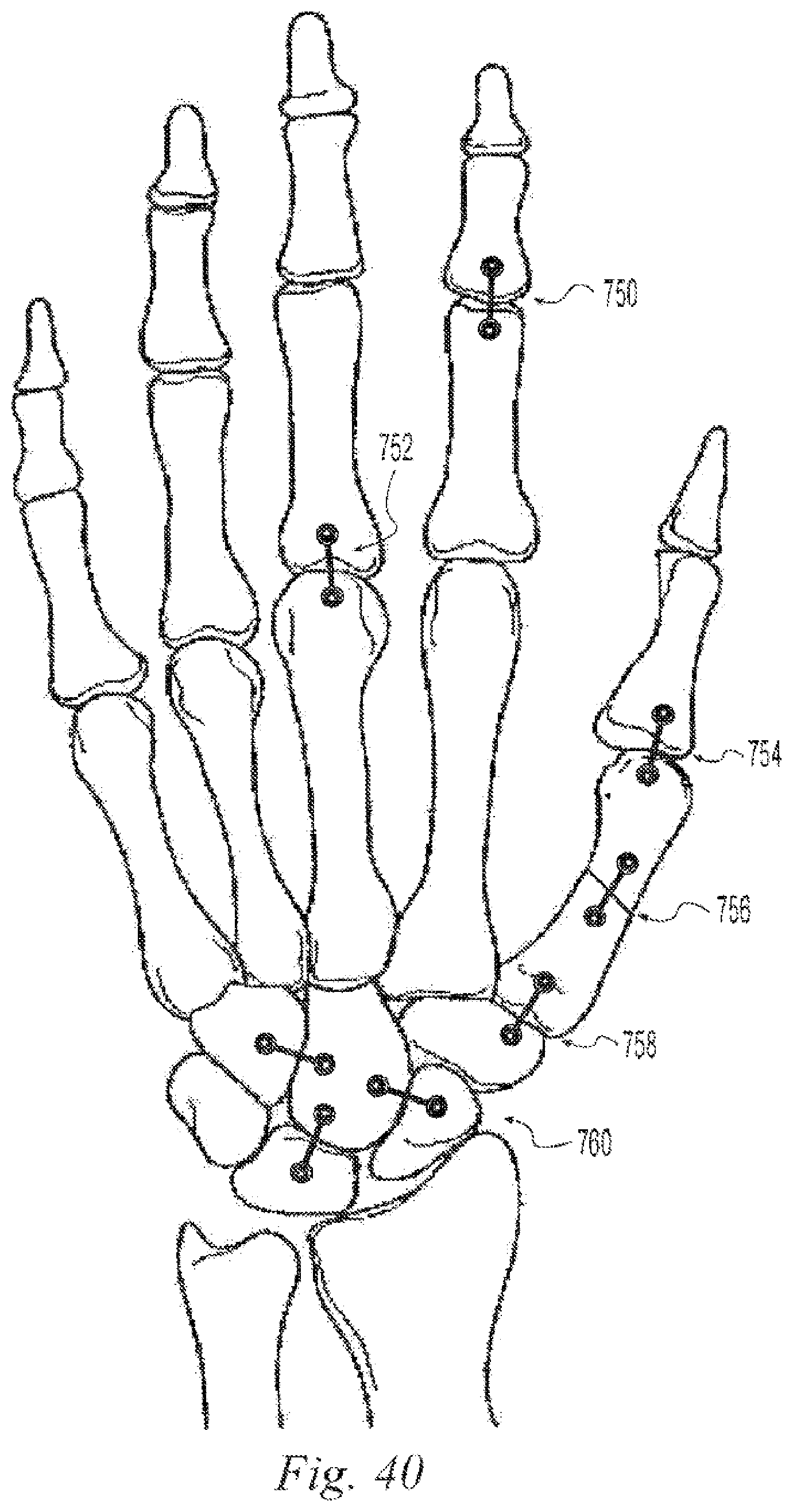Patent US12496108 Figure 17 – Orthopedic fasteners, instruments and methods