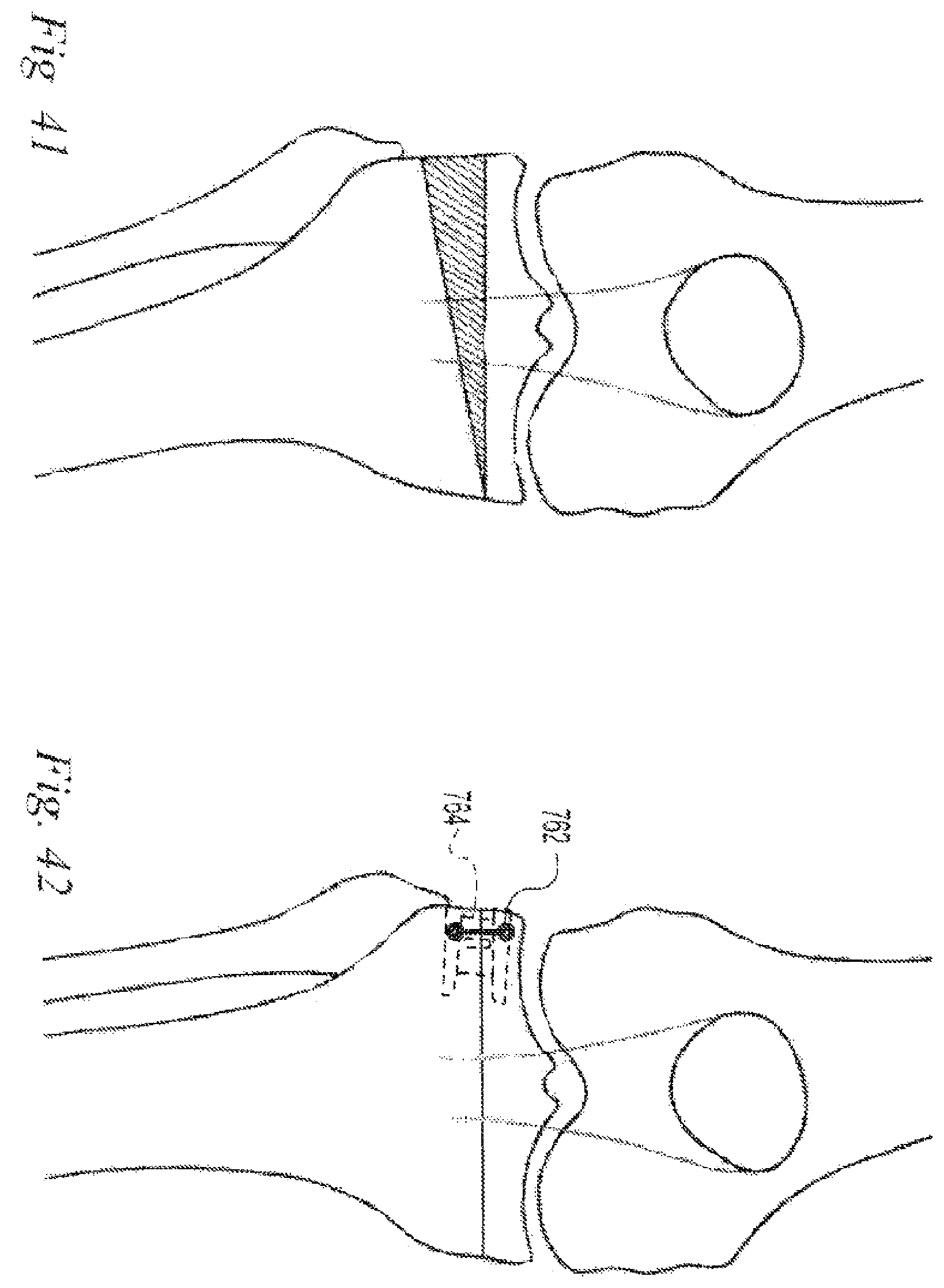 Patent US12496108 Figure 18 – Orthopedic fasteners, instruments and methods