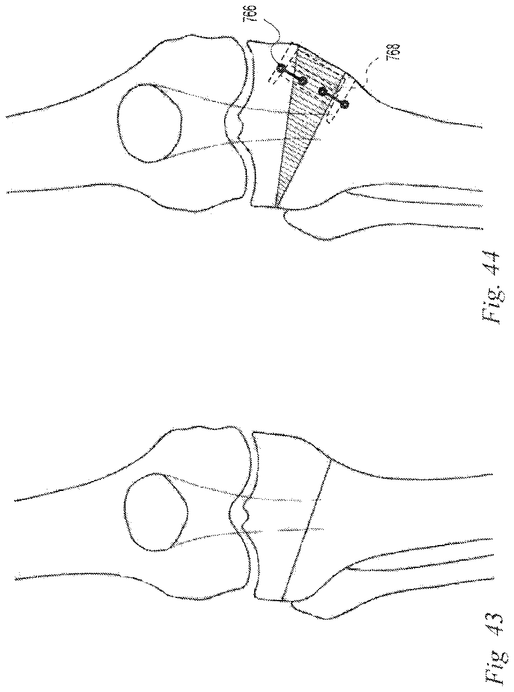 Patent US12496108 Figure 19 – Orthopedic fasteners, instruments and methods