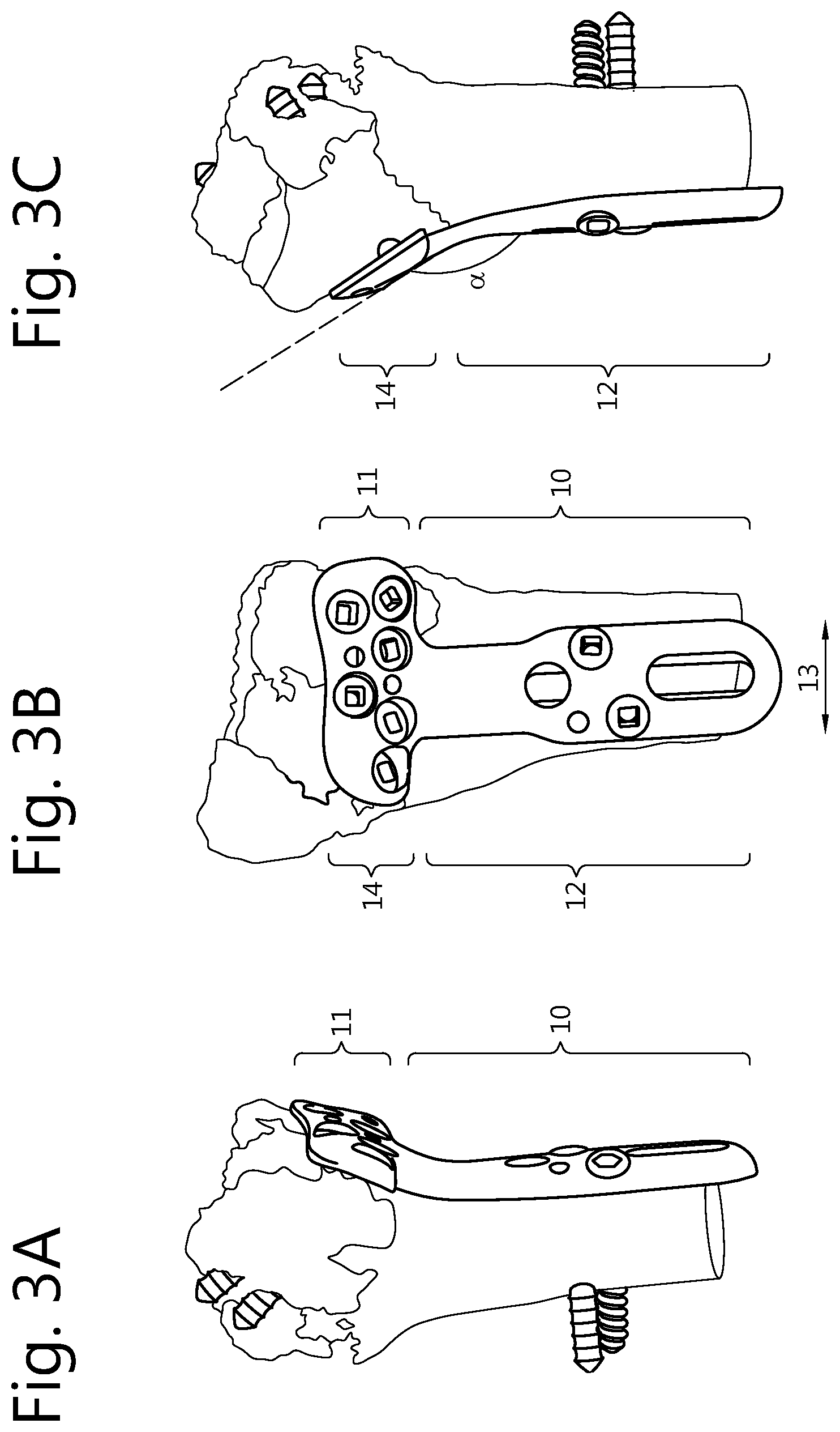Patent US12496109 Figure 2 – Implantable plate and method of manufacturing thereof