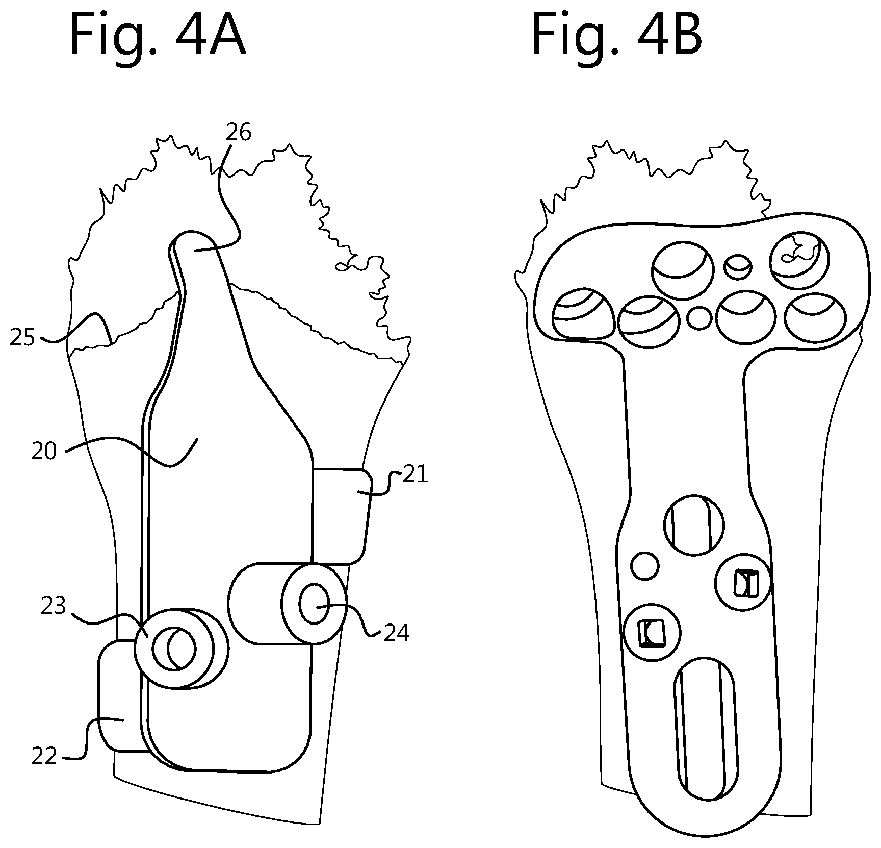 Patent US12496109 Figure 3 – Implantable plate and method of manufacturing thereof