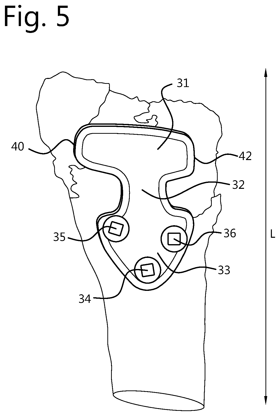Patent US12496109 Figure 4 – Implantable plate and method of manufacturing thereof