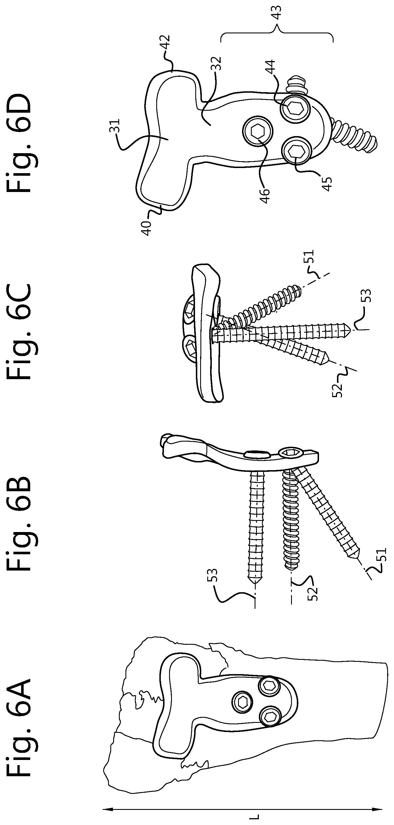 Patent US12496109 Figure 5 – Implantable plate and method of manufacturing thereof