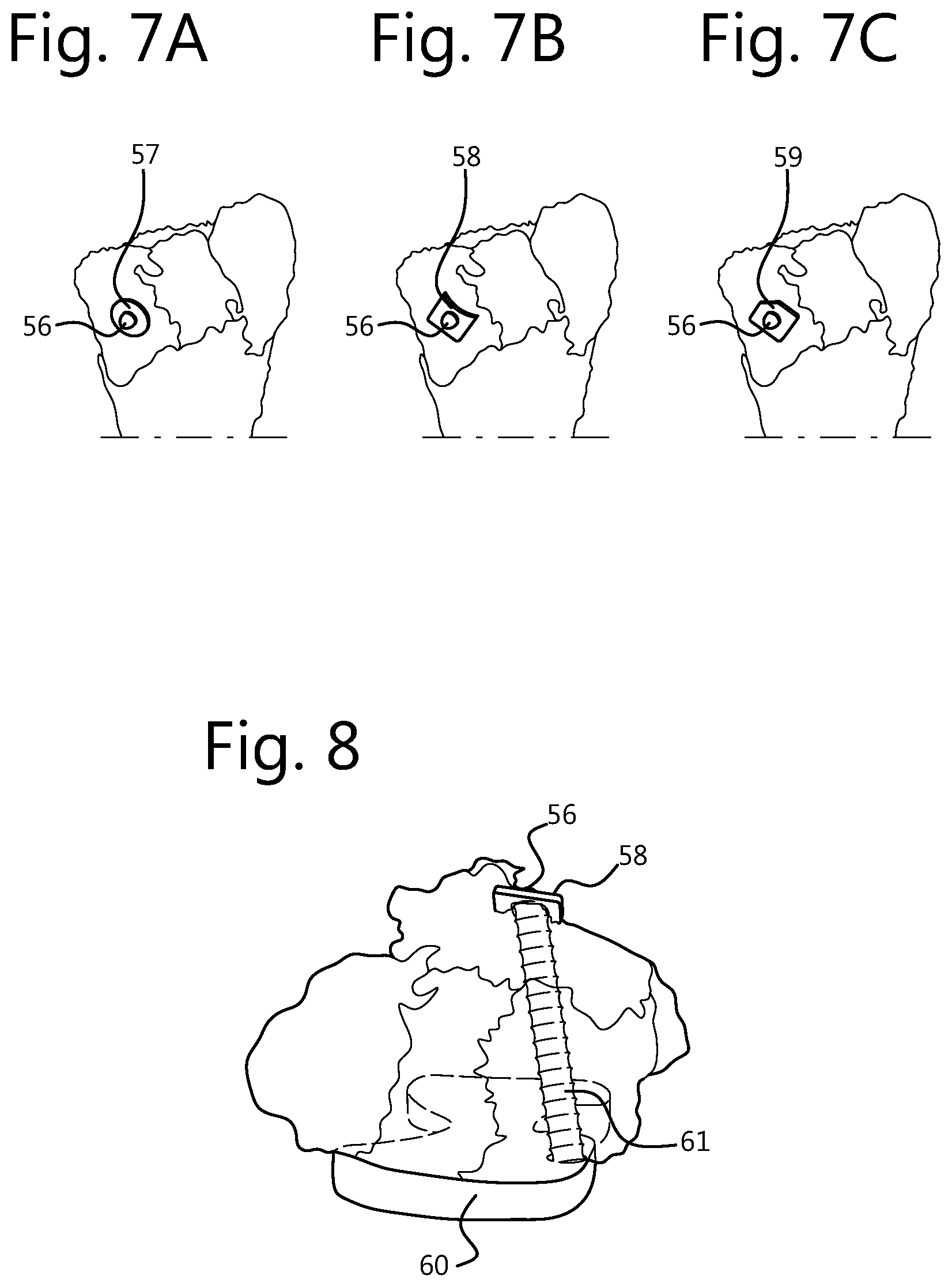Patent US12496109 Figure 6 – Implantable plate and method of manufacturing thereof