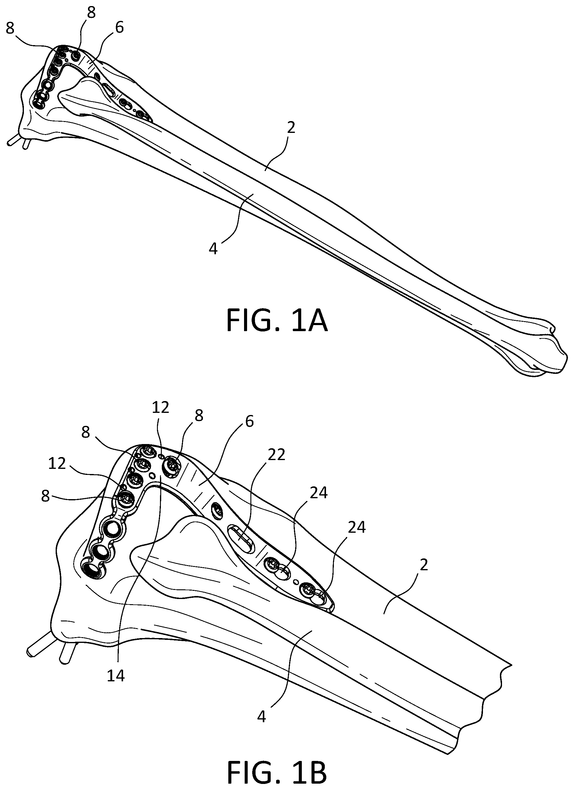 Patent US12496110 Figure 1 – Lateral proximal tibia plate with extension arm