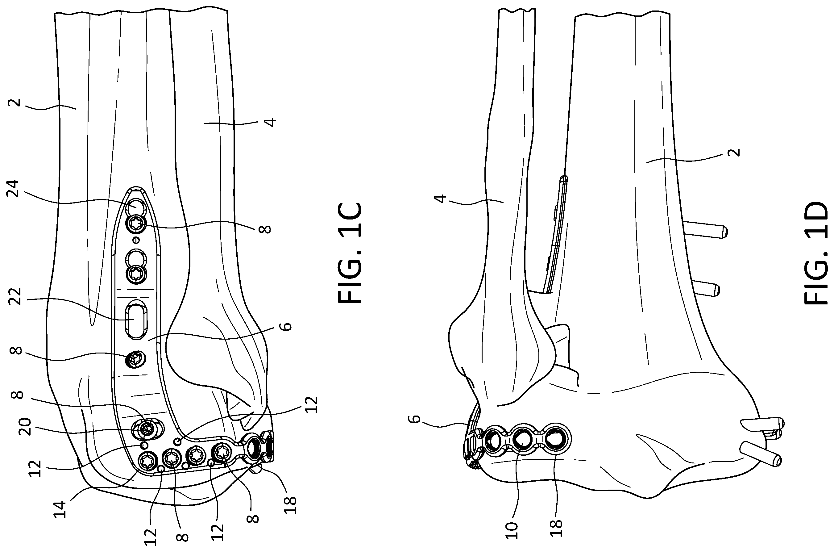 Patent US12496110 Figure 2 – Lateral proximal tibia plate with extension arm