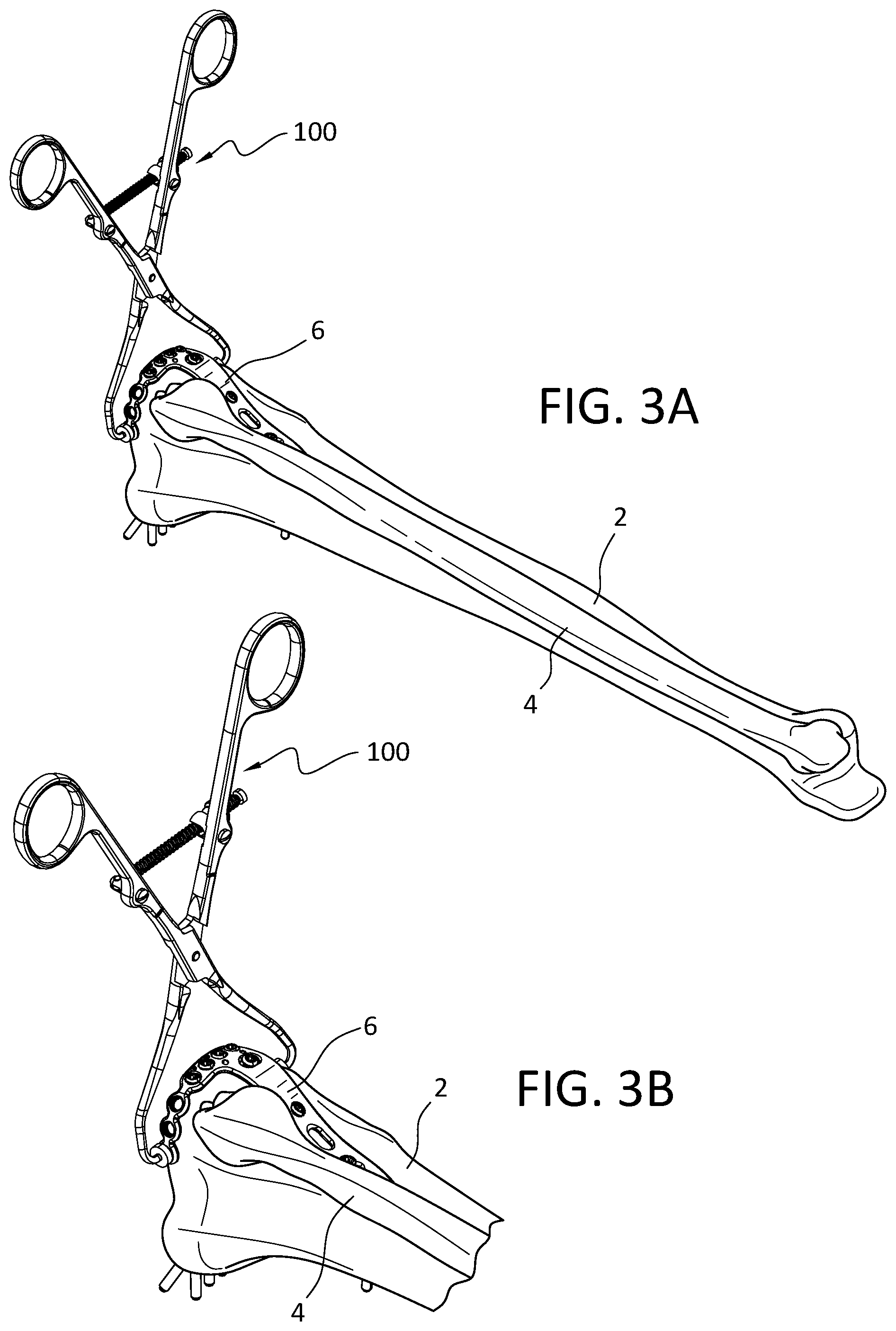 Patent US12496110 Figure 6 – Lateral proximal tibia plate with extension arm