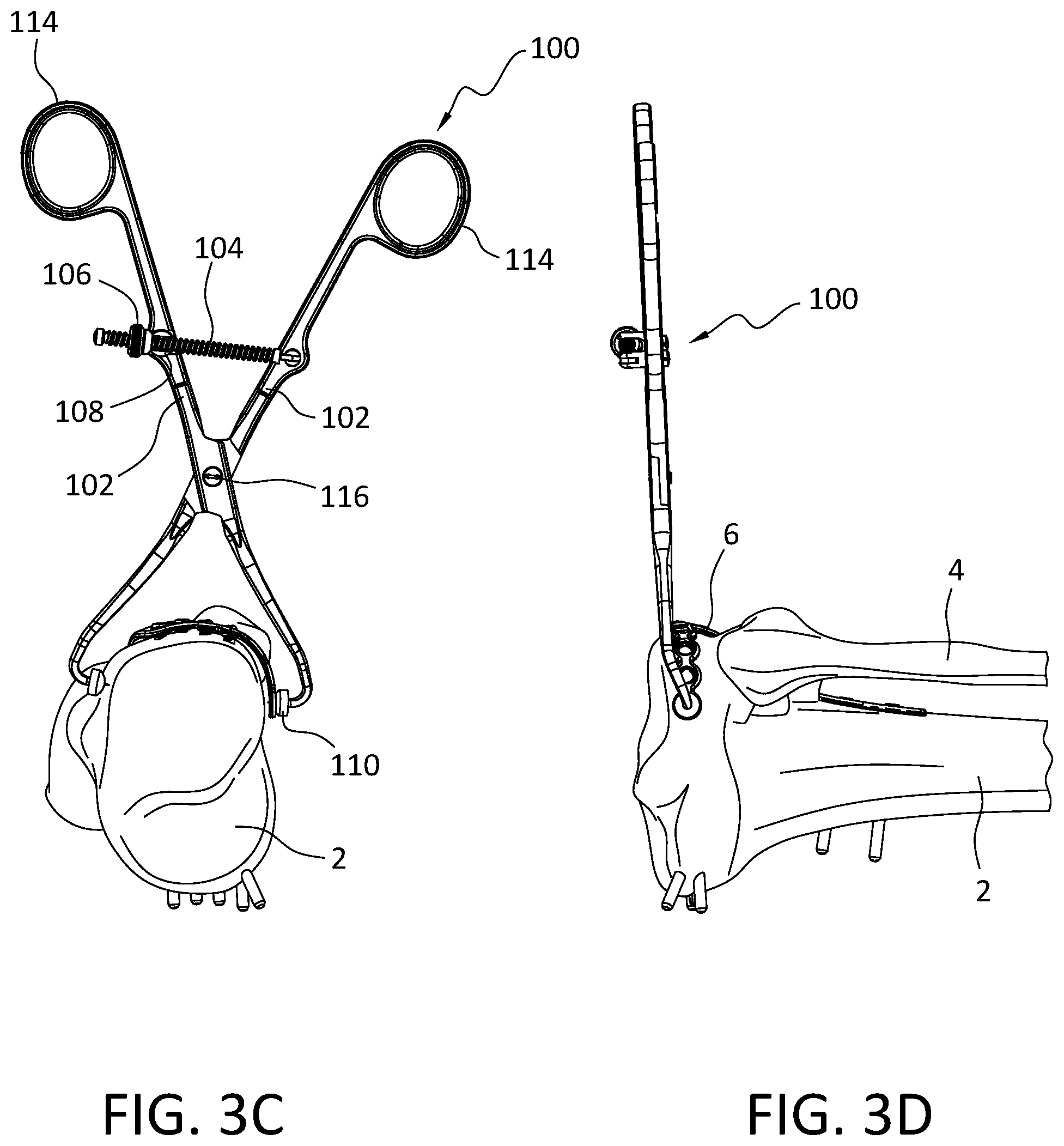 Patent US12496110 Figure 7 – Lateral proximal tibia plate with extension arm