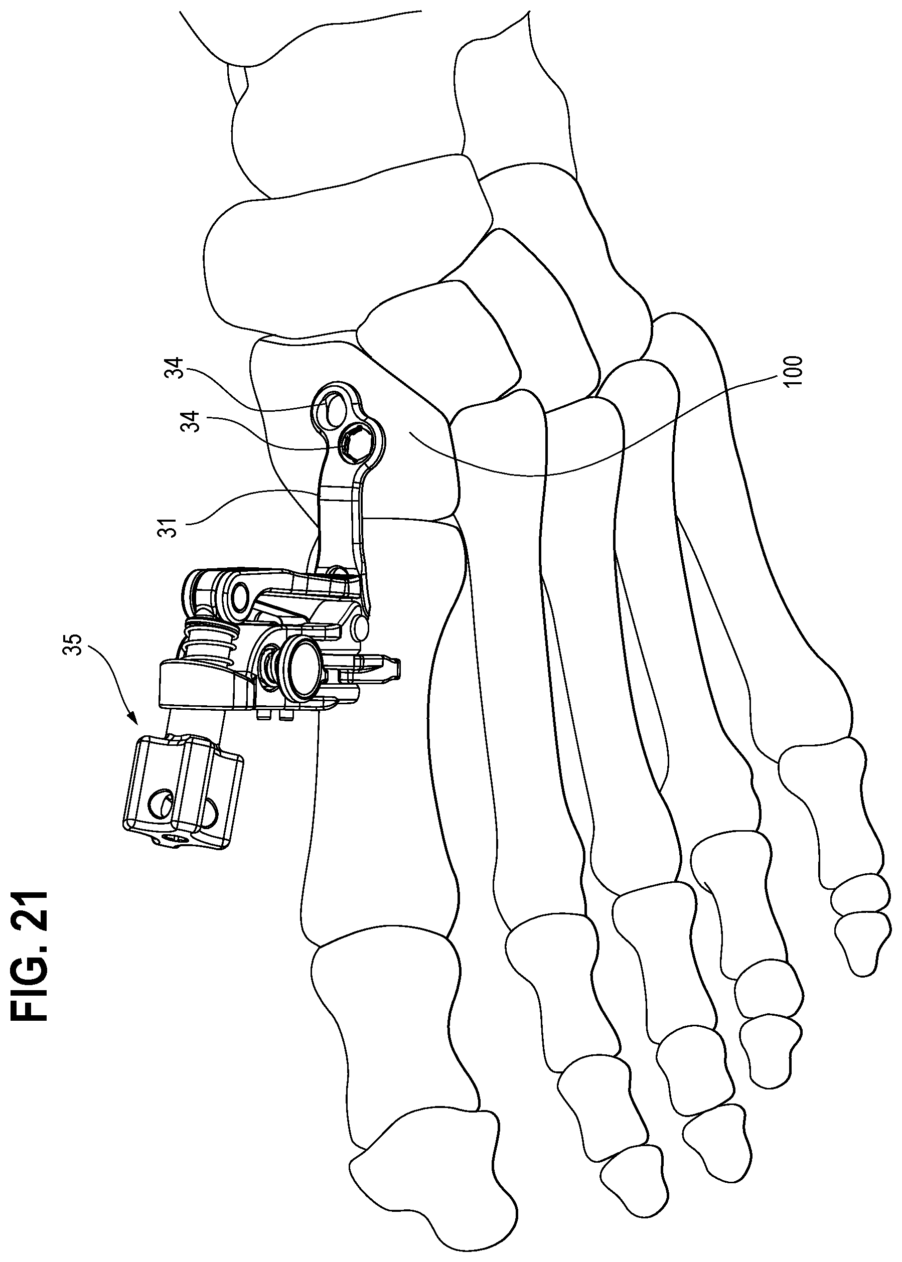 Patent US12496111 Figure 18 – Plate inserter tool