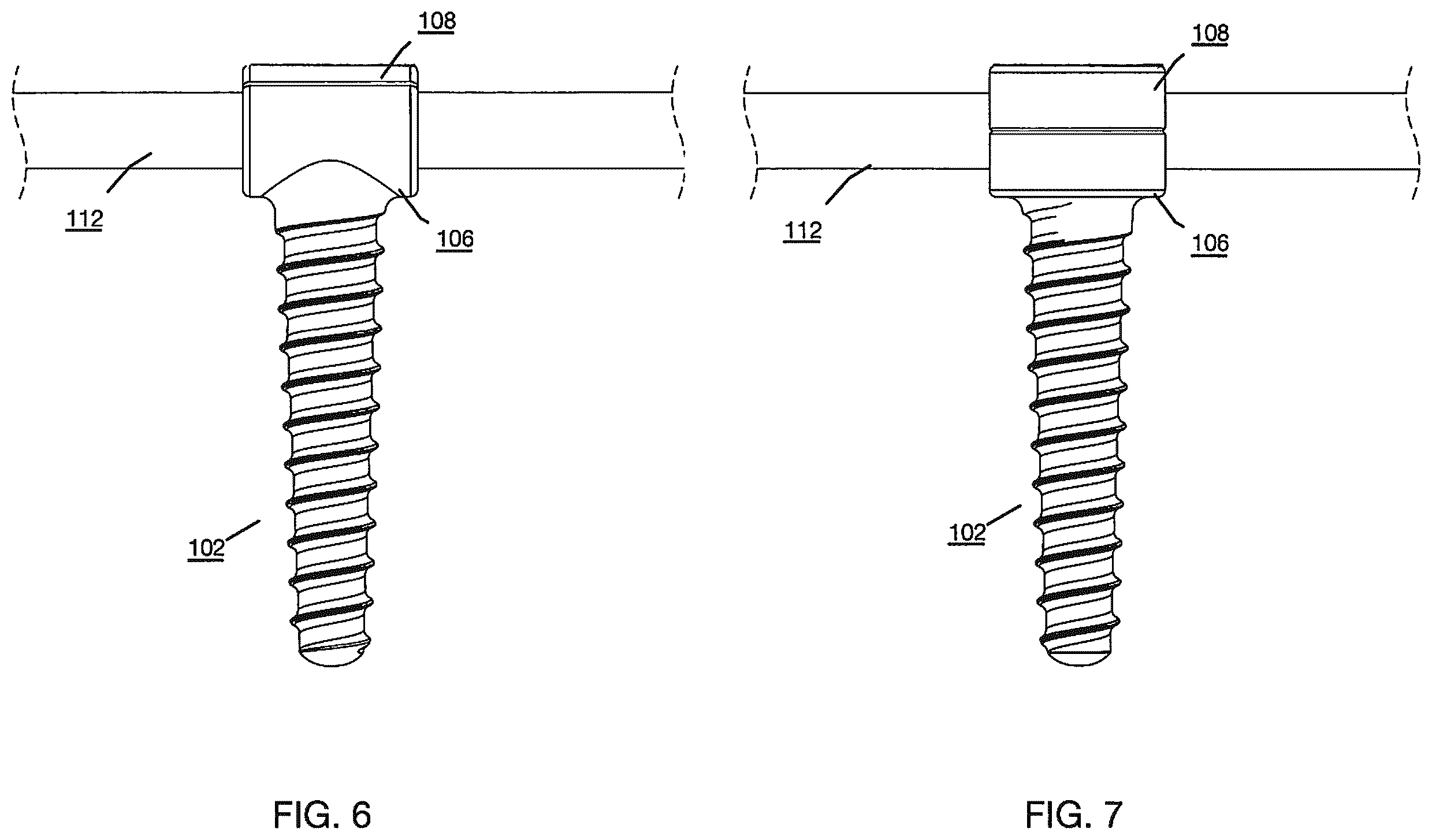 Patent US12496112 Figure 4 – Anchor device for bone implantation during surgical procedures