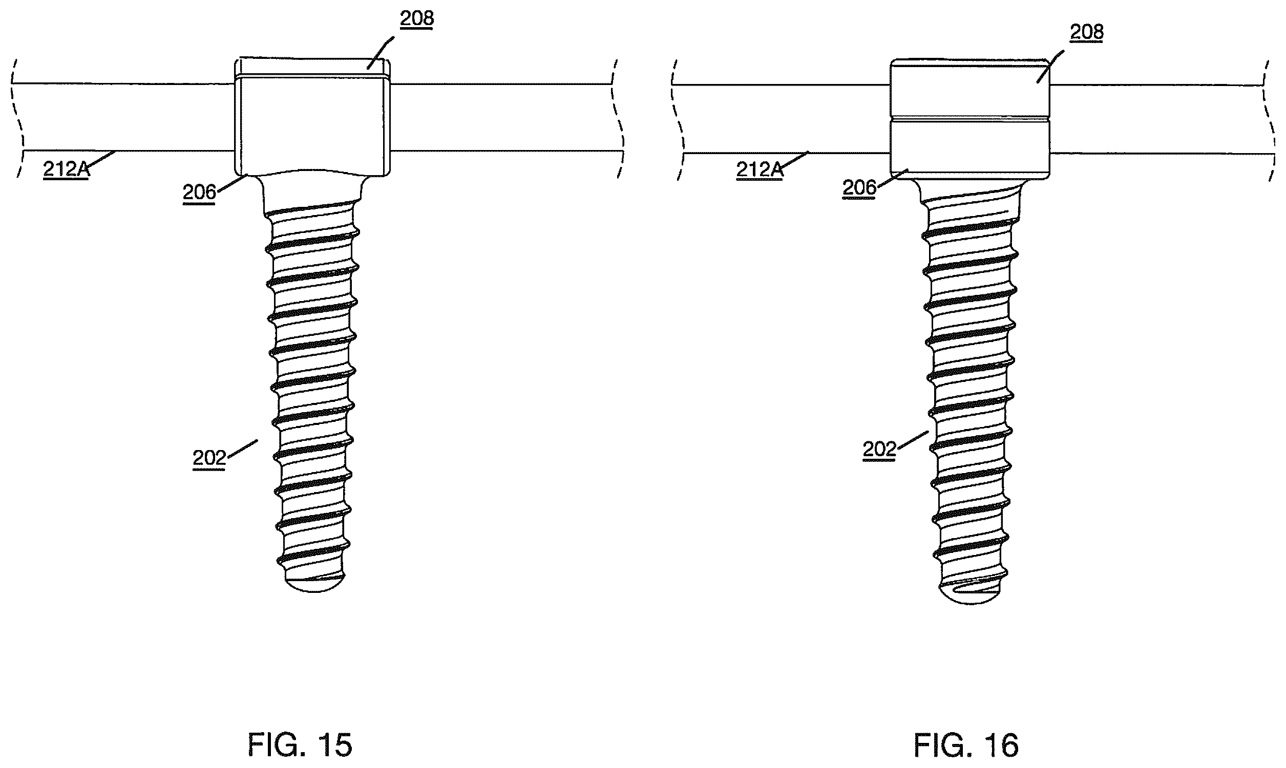 Patent US12496112 Figure 9 – Anchor device for bone implantation during surgical procedures