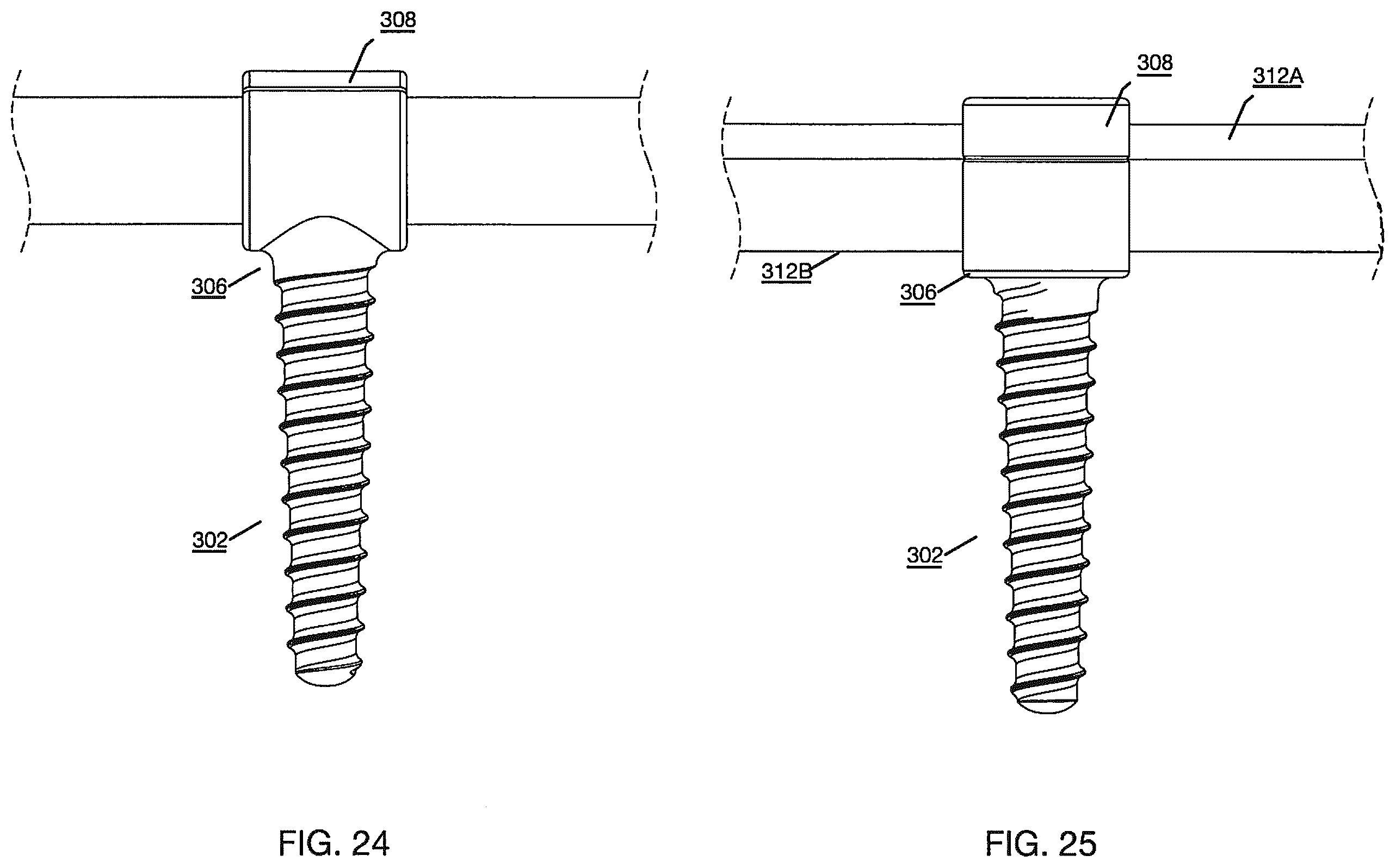 Patent US12496112 Figure 13 – Anchor device for bone implantation during surgical procedures