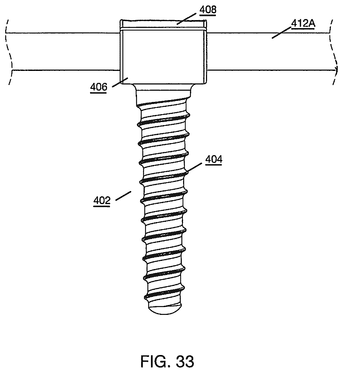 Patent US12496112 Figure 17 – Anchor device for bone implantation during surgical procedures