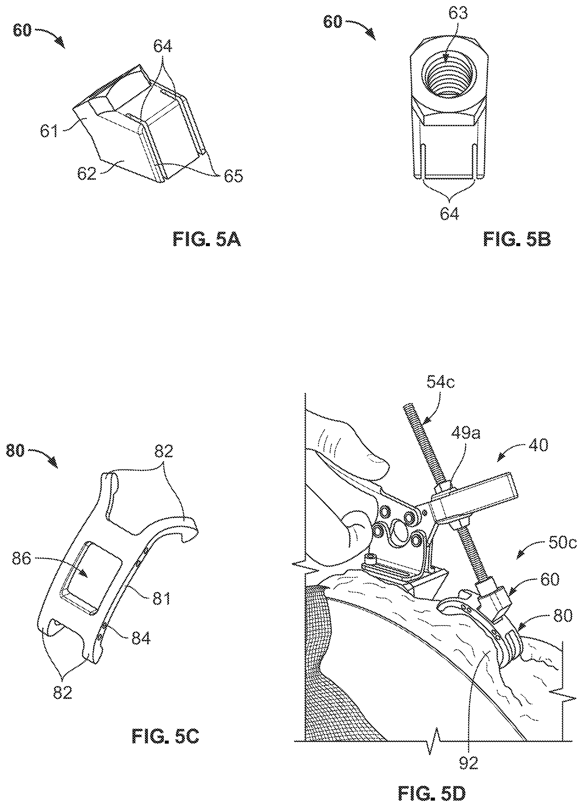 Patent US12496113 Figure 3 – Bone reattachment system