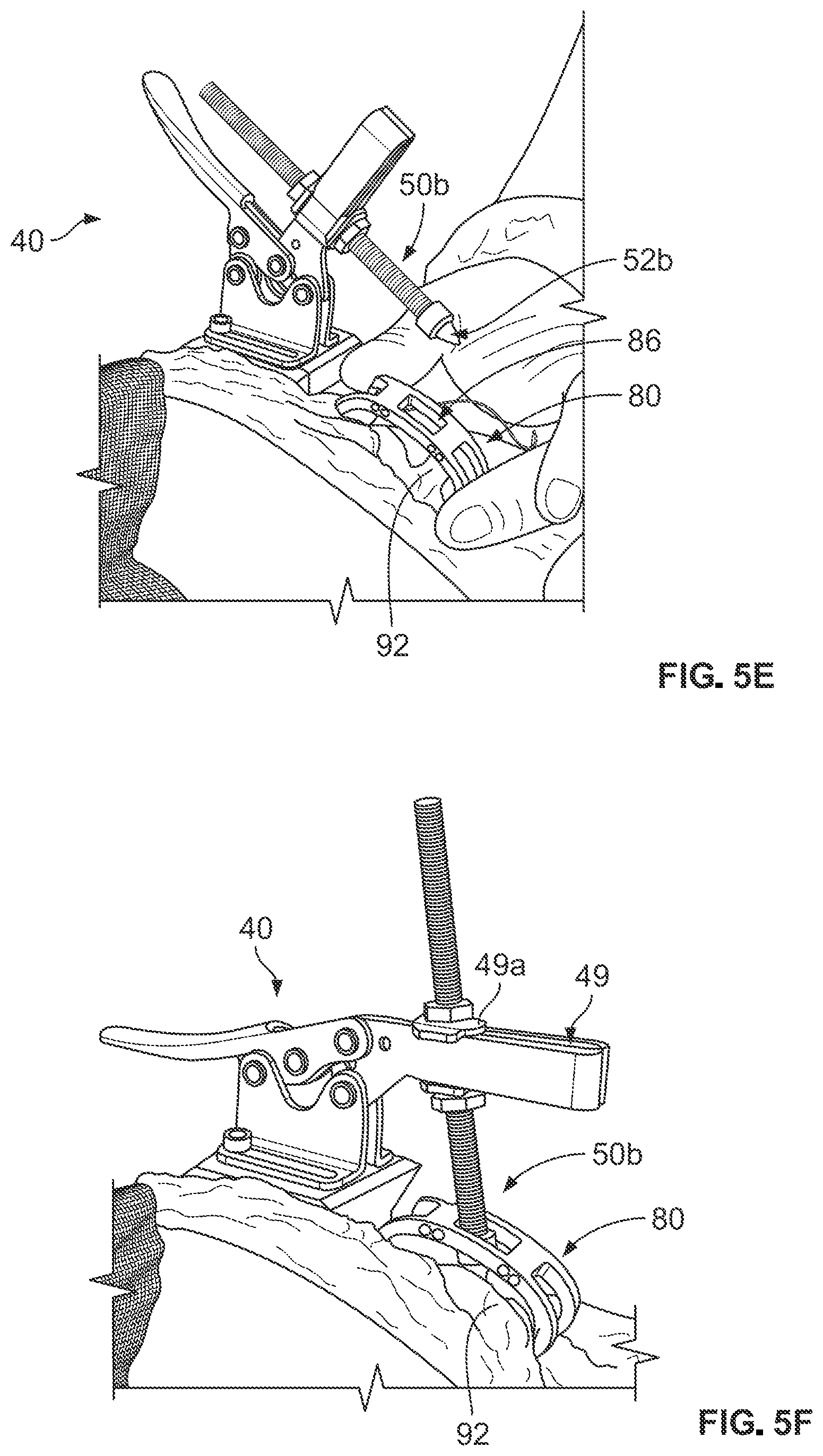 Patent US12496113 Figure 4 – Bone reattachment system