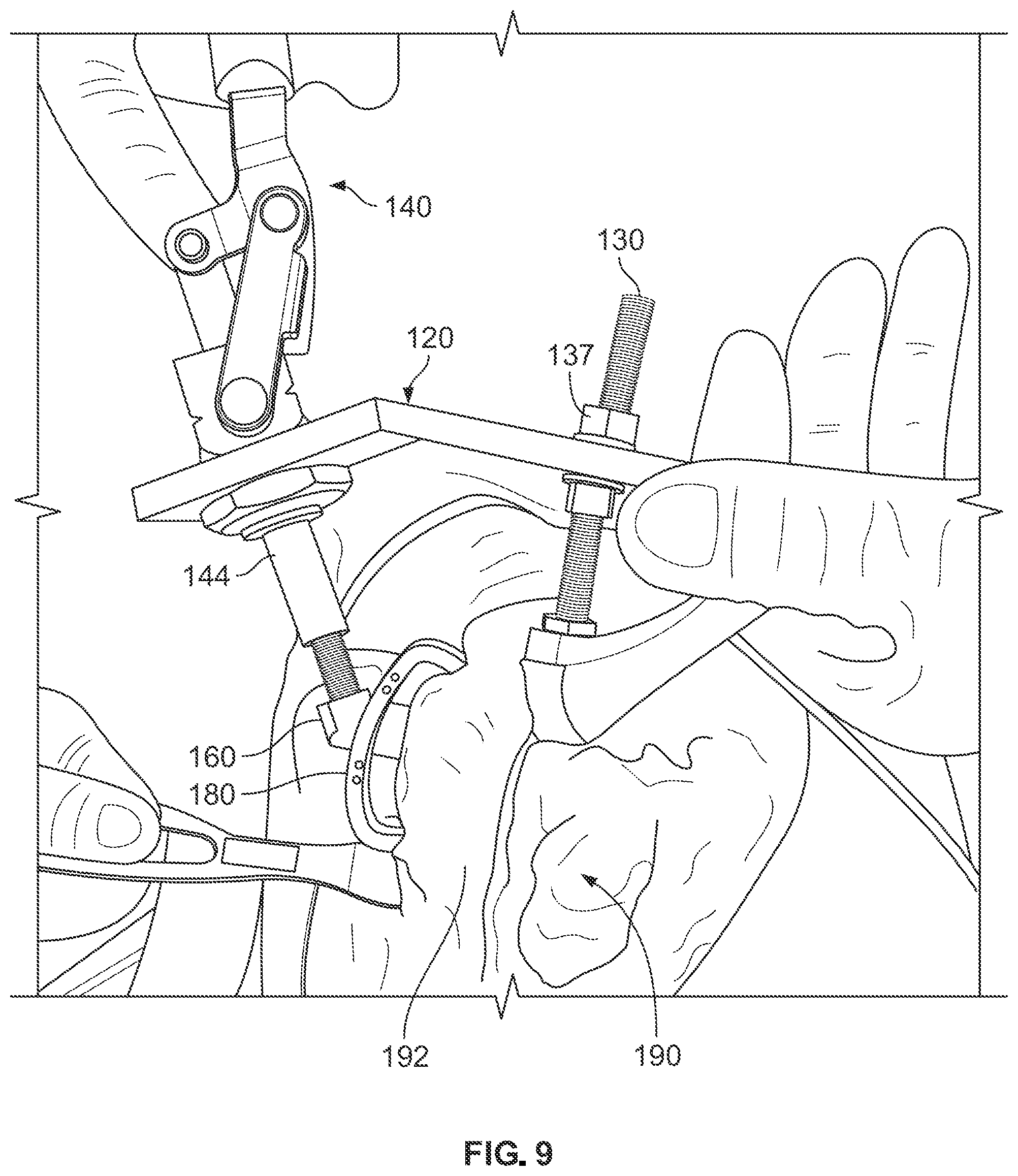 Patent US12496113 Figure 7 – Bone reattachment system