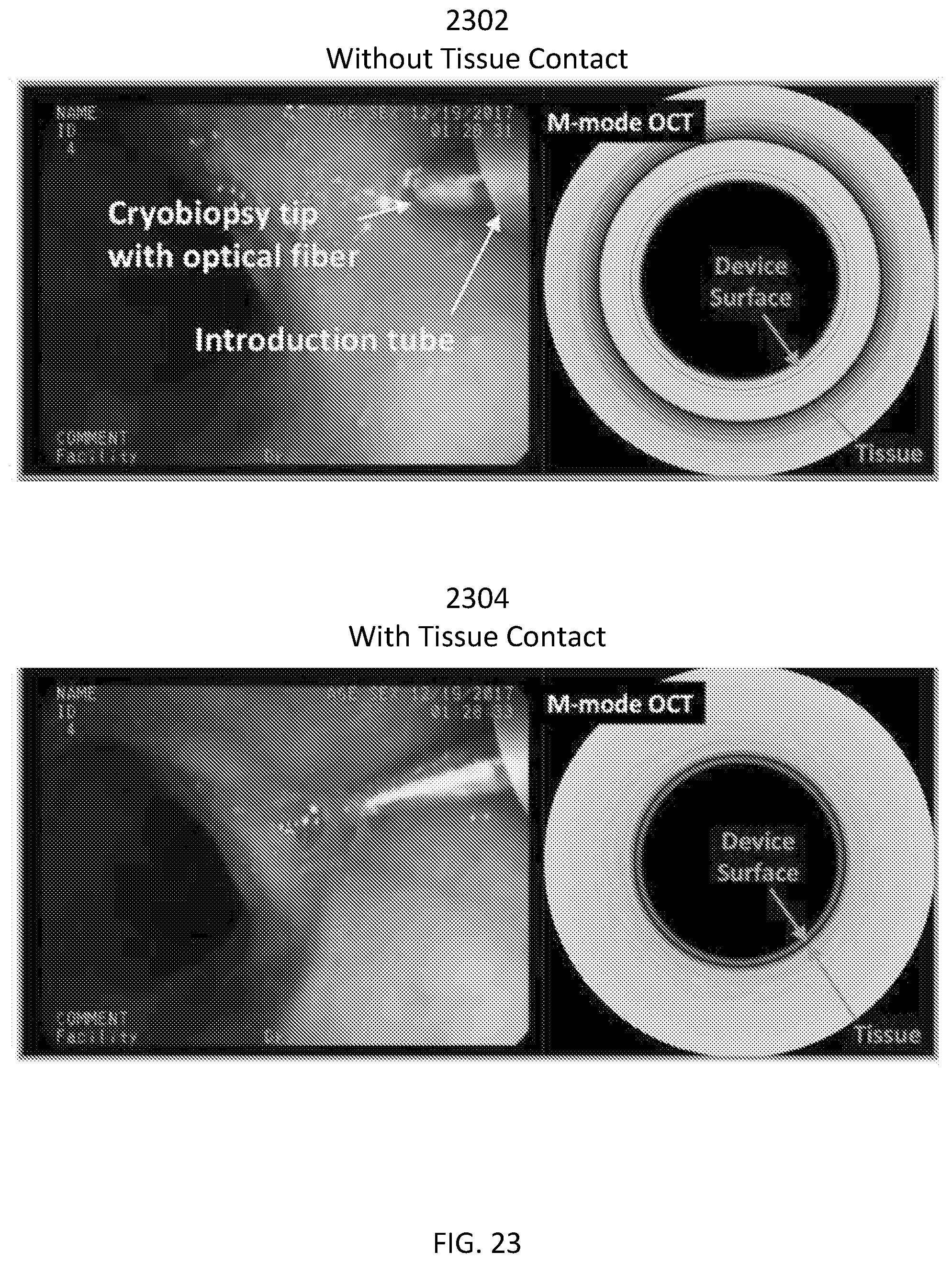 Patent US12496115 Figure 13 – Devices, systems, and methods for cryogenic biopsy sampling