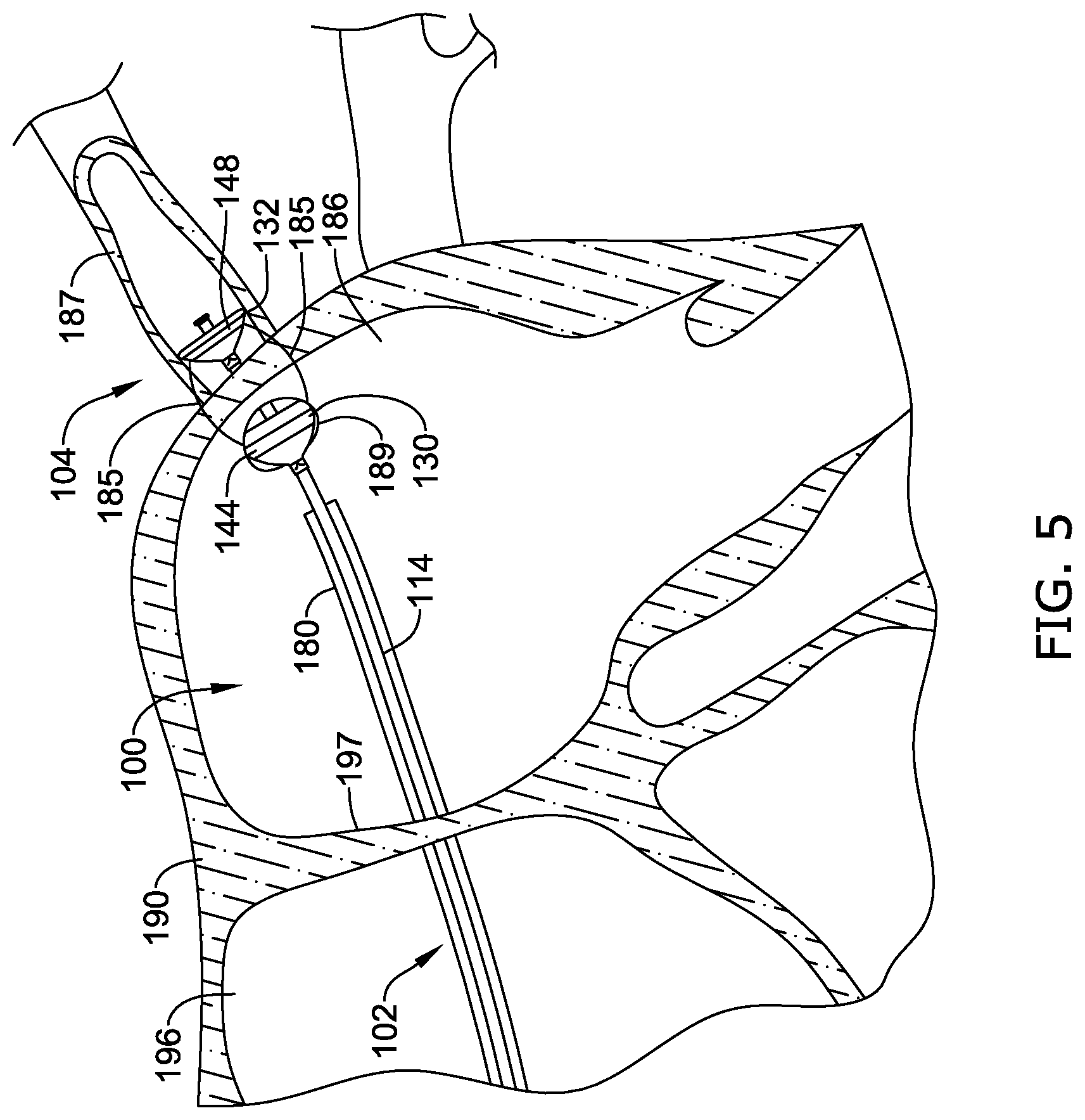 Patent US12496122 Figure 5 – Ablation and occlusive system