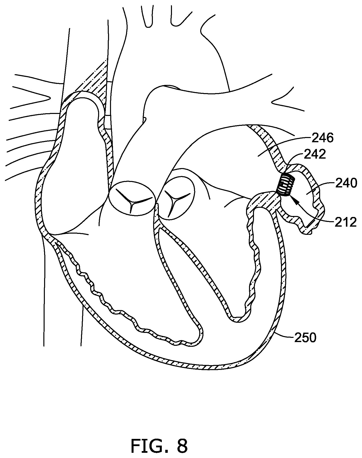 Patent US12496122 Figure 8 – Ablation and occlusive system