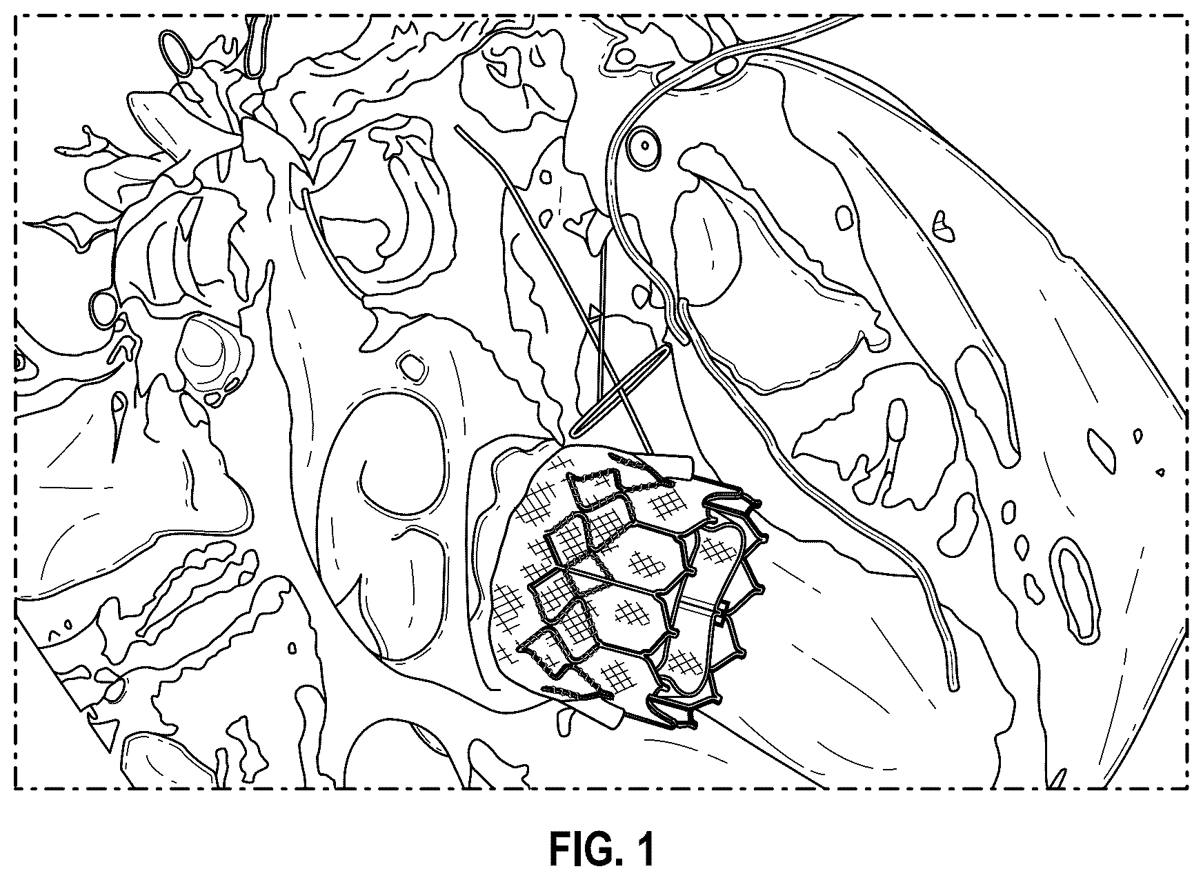 Patent US12496126 Figure 1 – Tissue cutting systems and methods