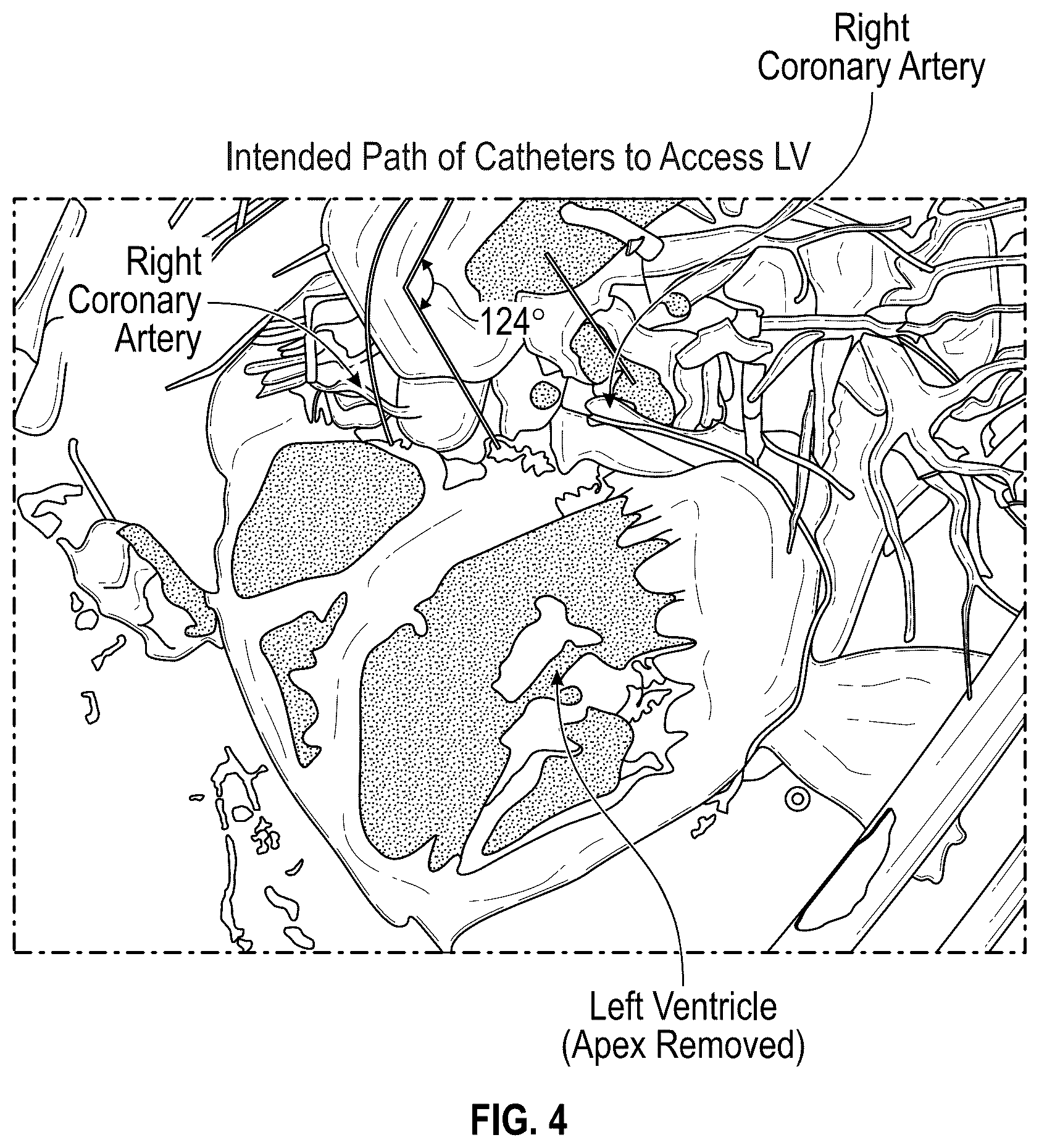 Patent US12496126 Figure 4 – Tissue cutting systems and methods