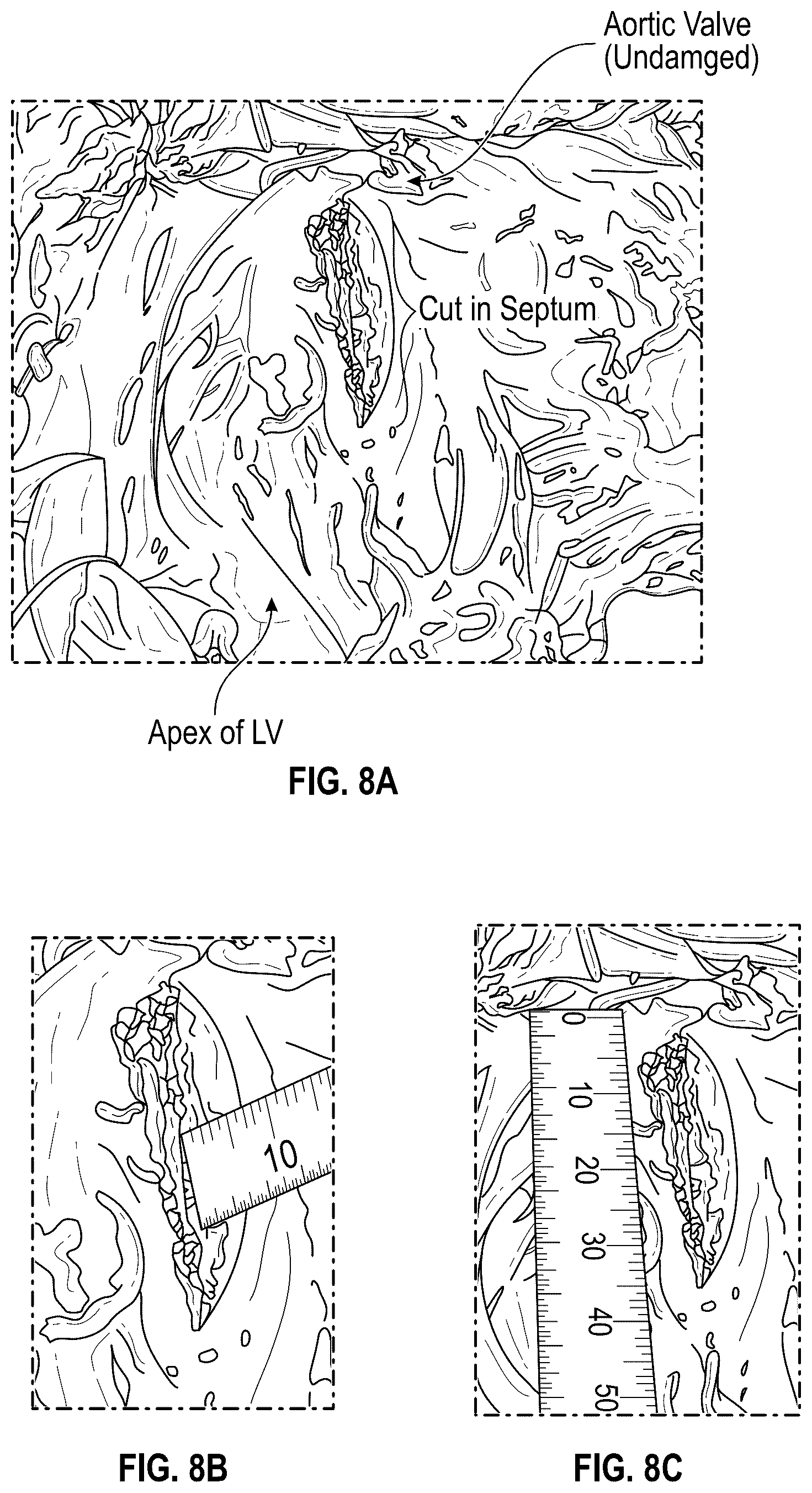 Patent US12496126 Figure 9 – Tissue cutting systems and methods