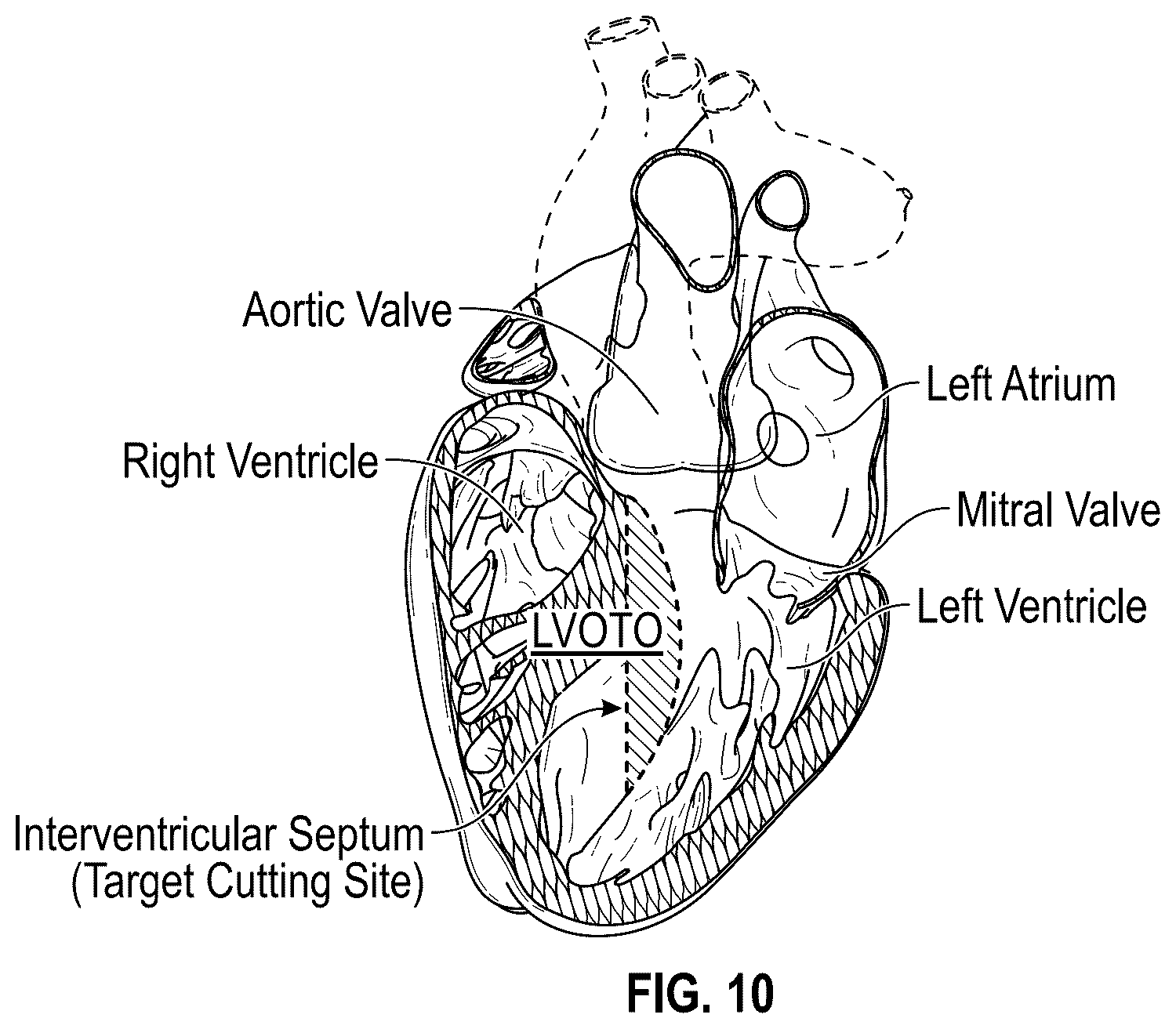 Patent US12496126 Figure 11 – Tissue cutting systems and methods