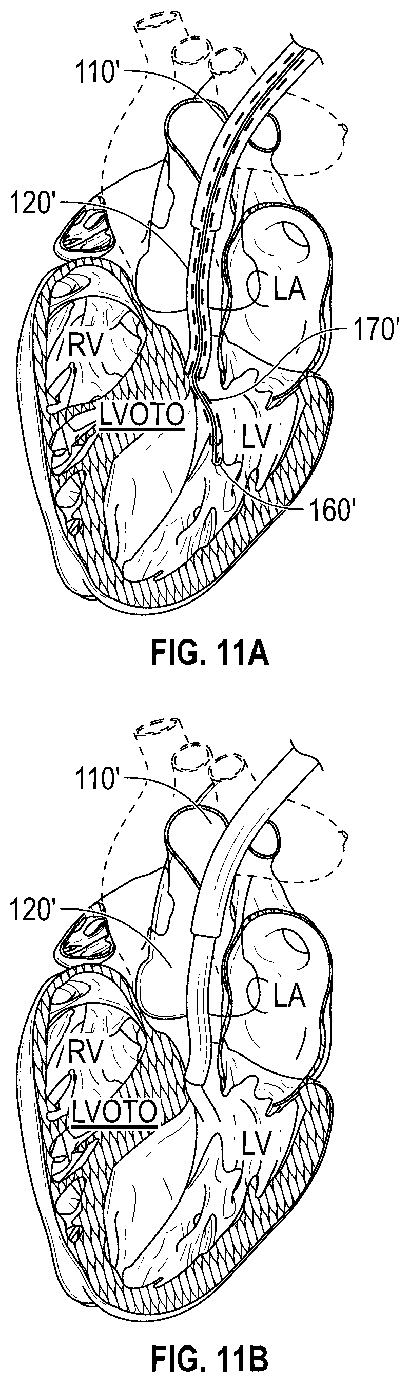 Patent US12496126 Figure 12 – Tissue cutting systems and methods