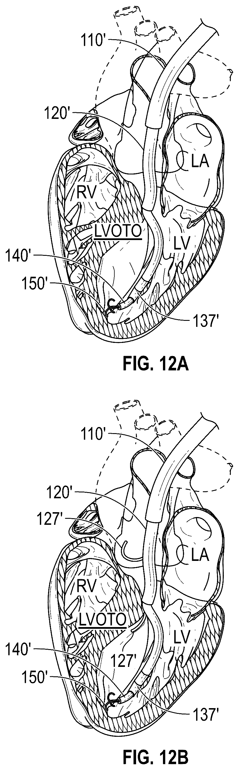 Patent US12496126 Figure 13 – Tissue cutting systems and methods