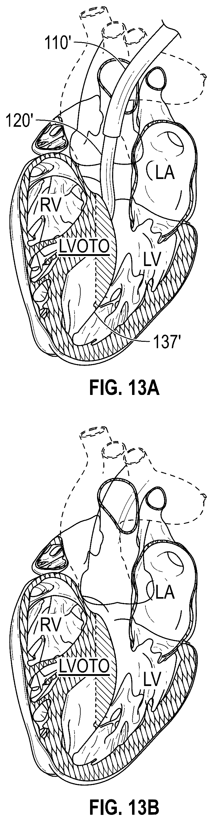 Patent US12496126 Figure 14 – Tissue cutting systems and methods