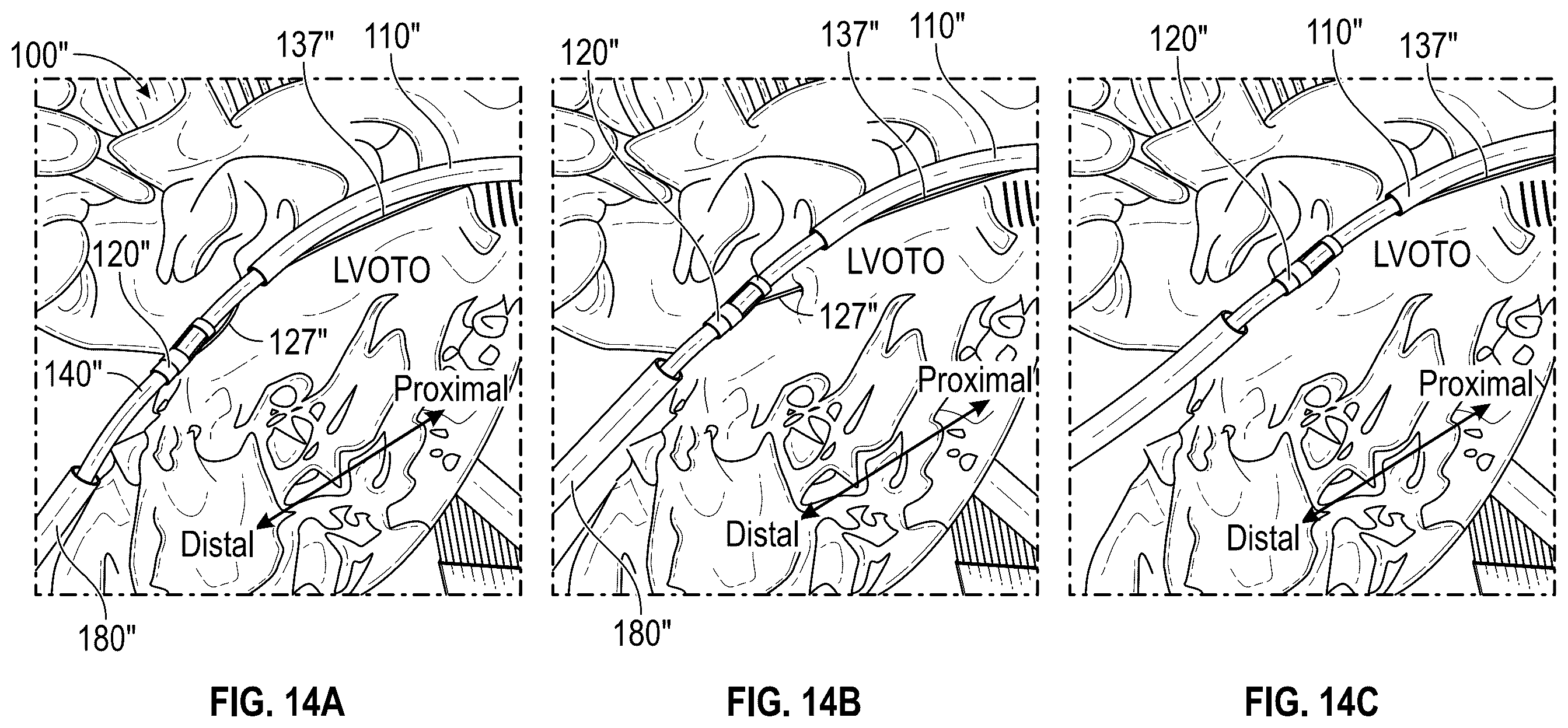 Patent US12496126 Figure 15 – Tissue cutting systems and methods