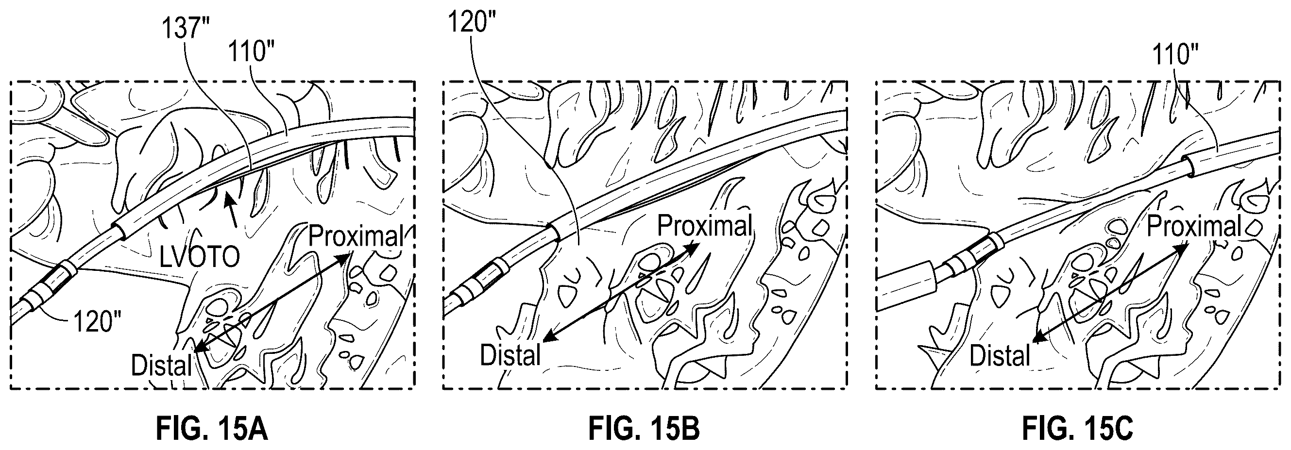 Patent US12496126 Figure 16 – Tissue cutting systems and methods