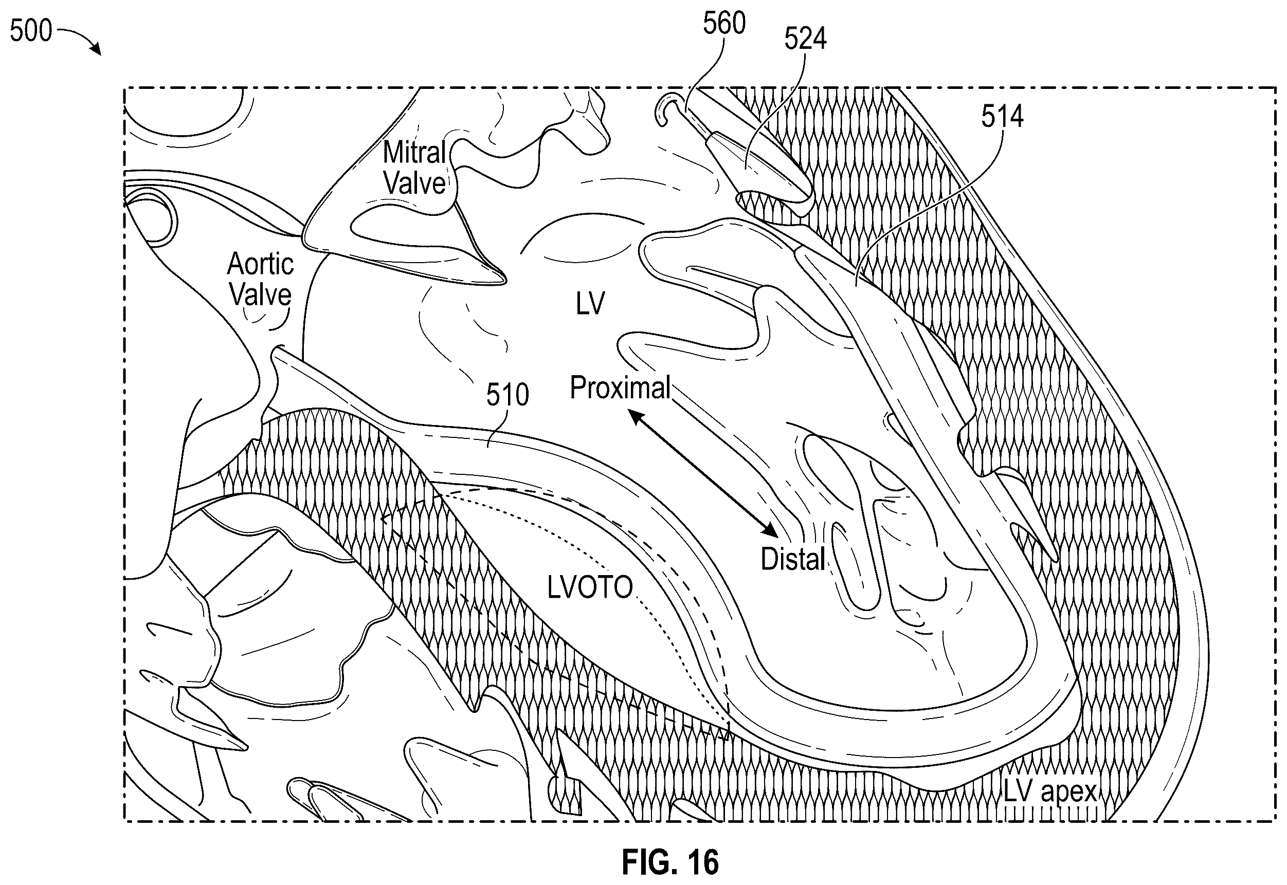 Patent US12496126 Figure 17 – Tissue cutting systems and methods