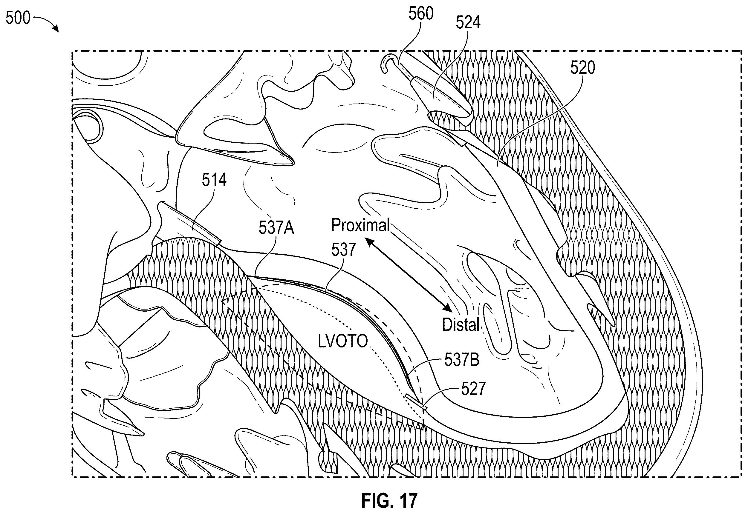 Patent US12496126 Figure 18 – Tissue cutting systems and methods