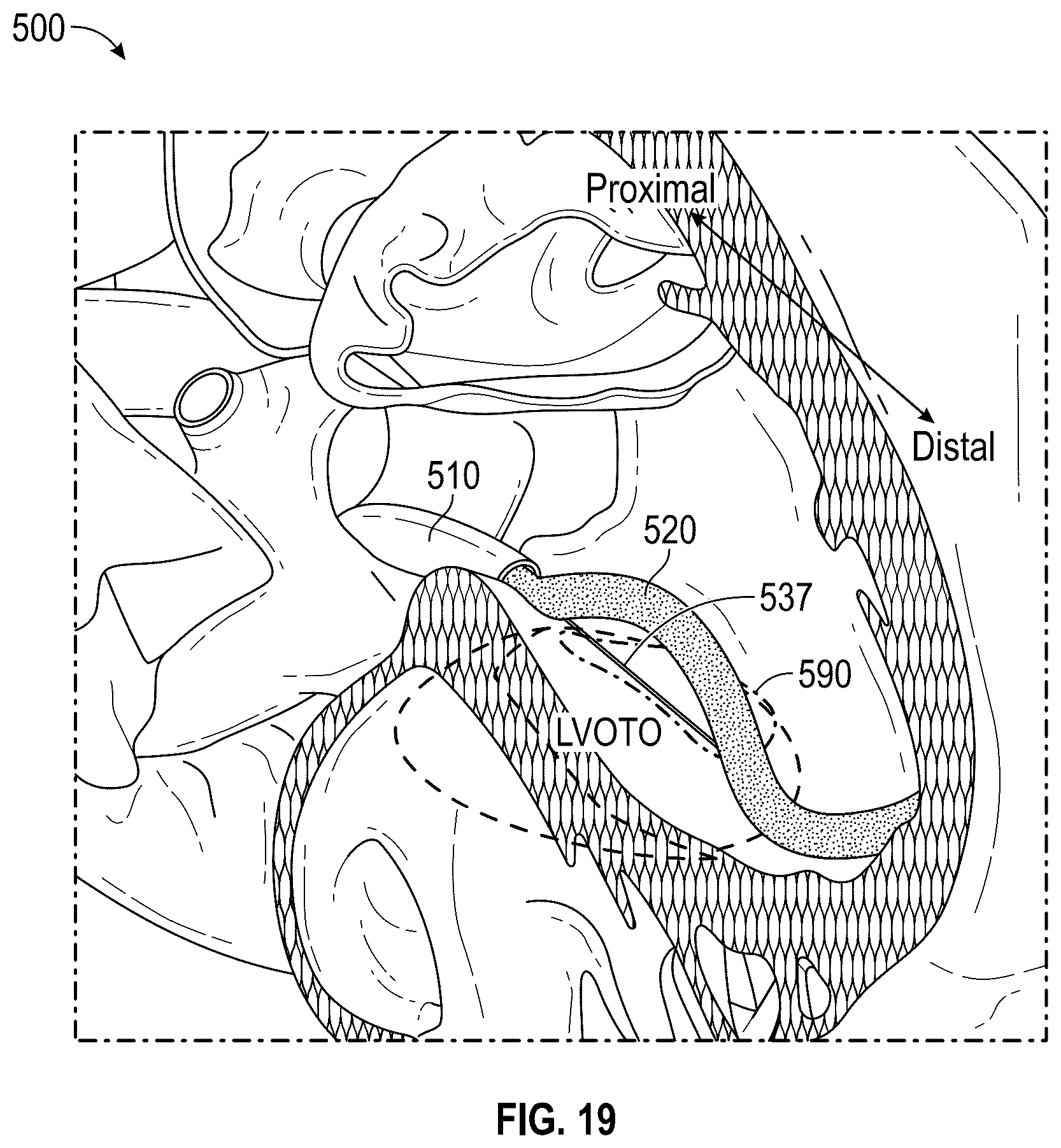 Patent US12496126 Figure 20 – Tissue cutting systems and methods