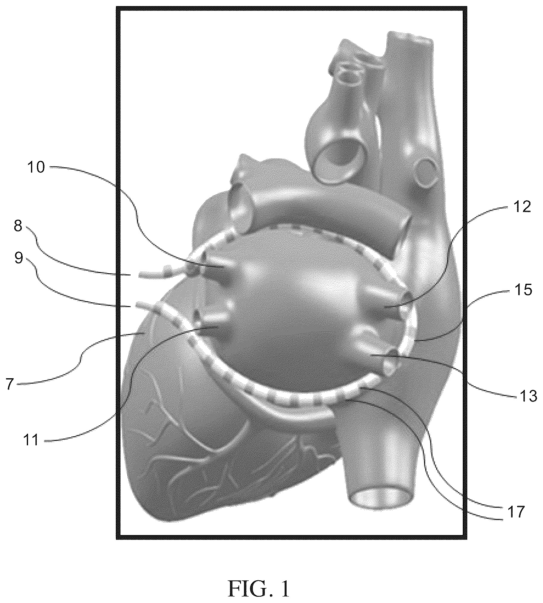 Patent US12496128 — Methods and apparatus for selective tissue ablation — Figure 1