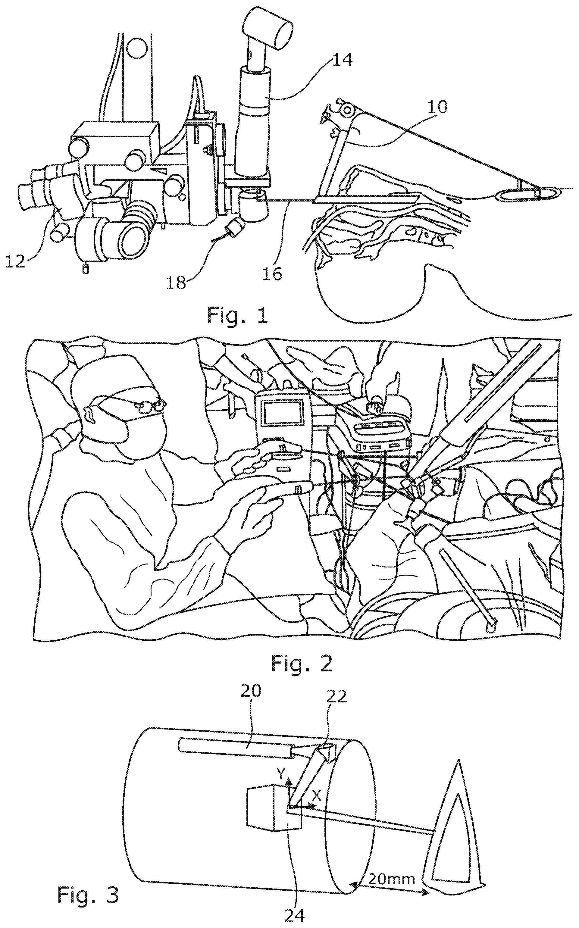 Patent US12496131 Figure 1 – Trans-oral surgery device comprising a blade with a distal scaffold and a support adjustable through tendons