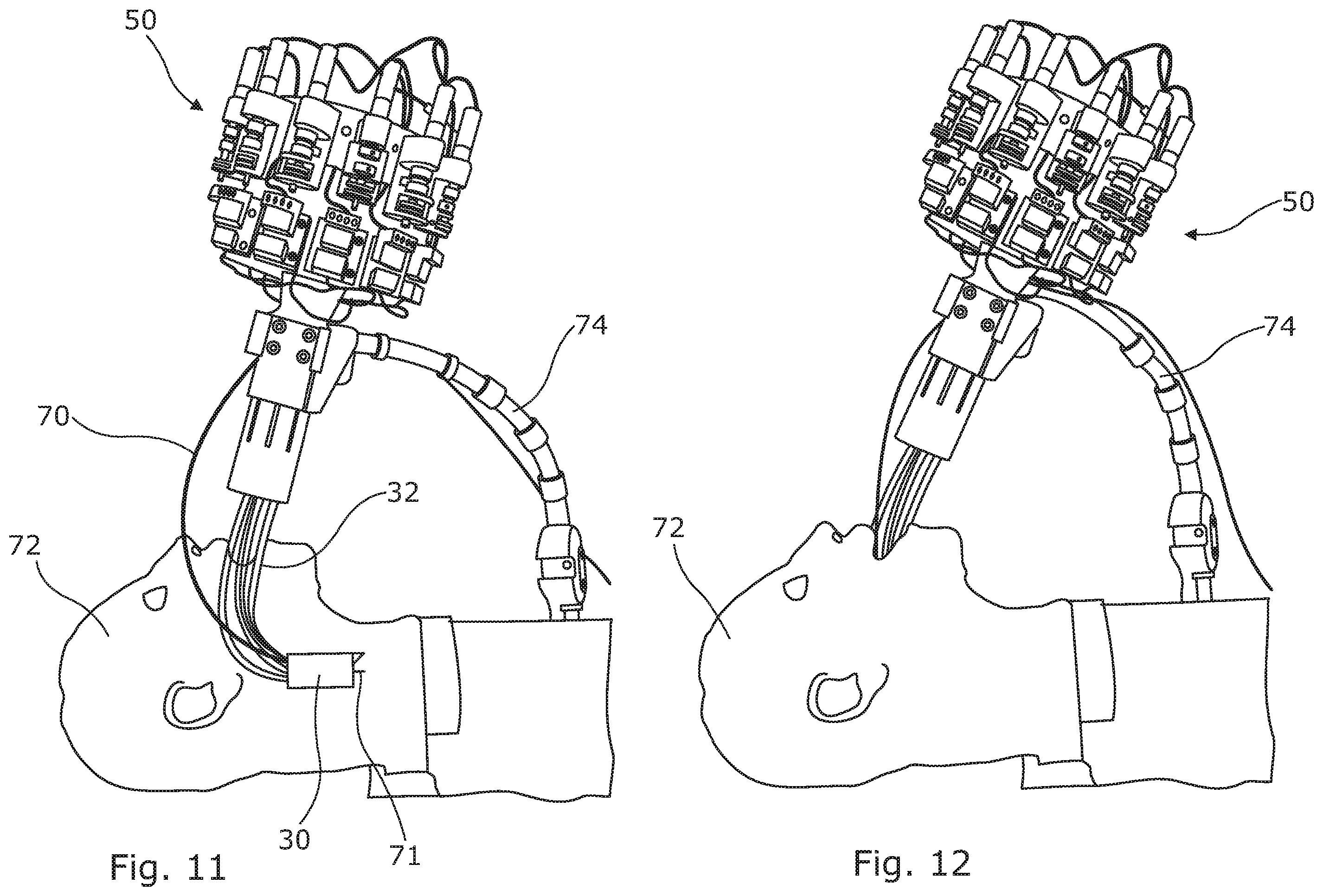 Patent US12496131 Figure 6 – Trans-oral surgery device comprising a blade with a distal scaffold and a support adjustable through tendons